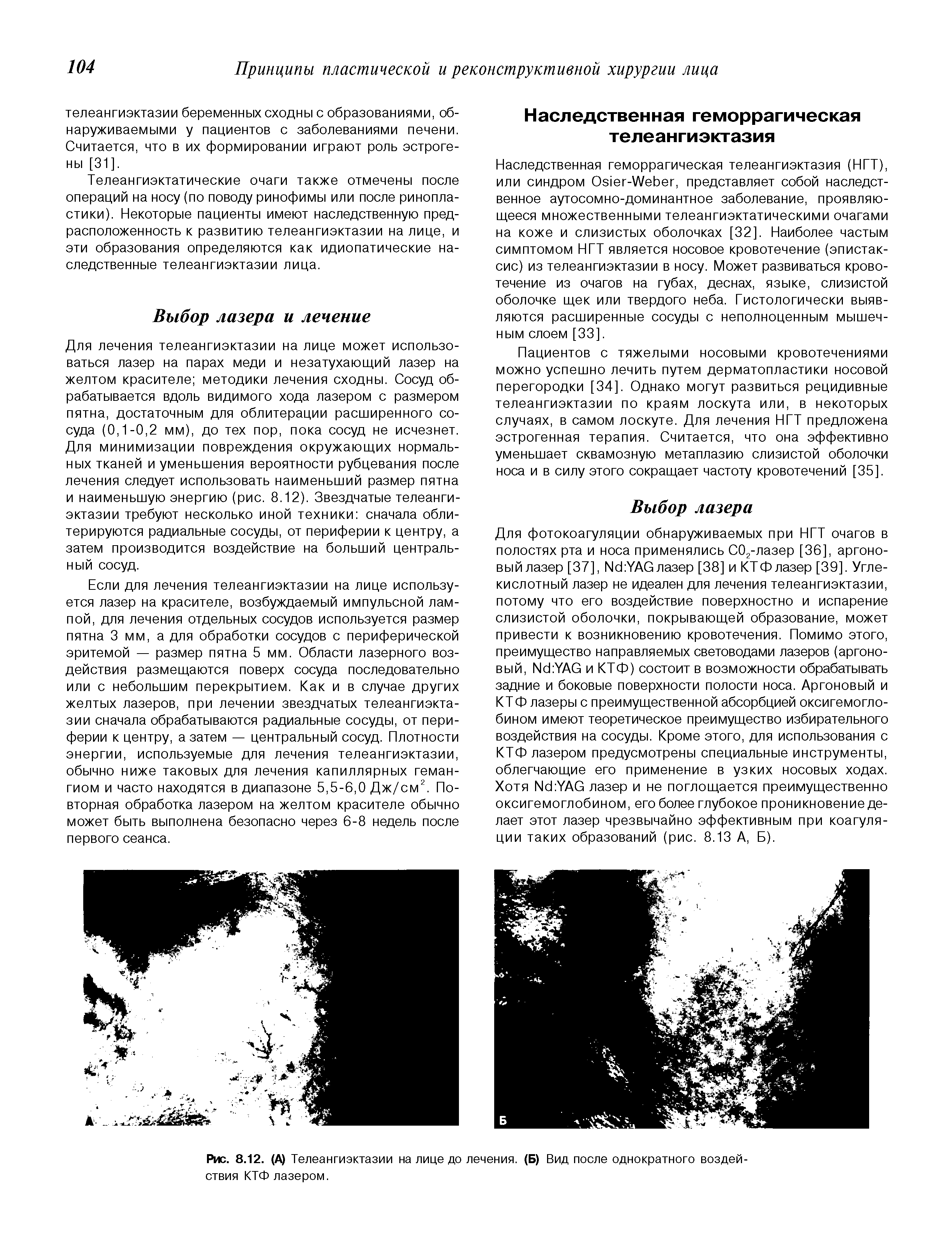 Рис. 8.12. (А) Телеангиэктазии на лице до лечения. (Б) Вид после однократного воздействия КТФ лазером.