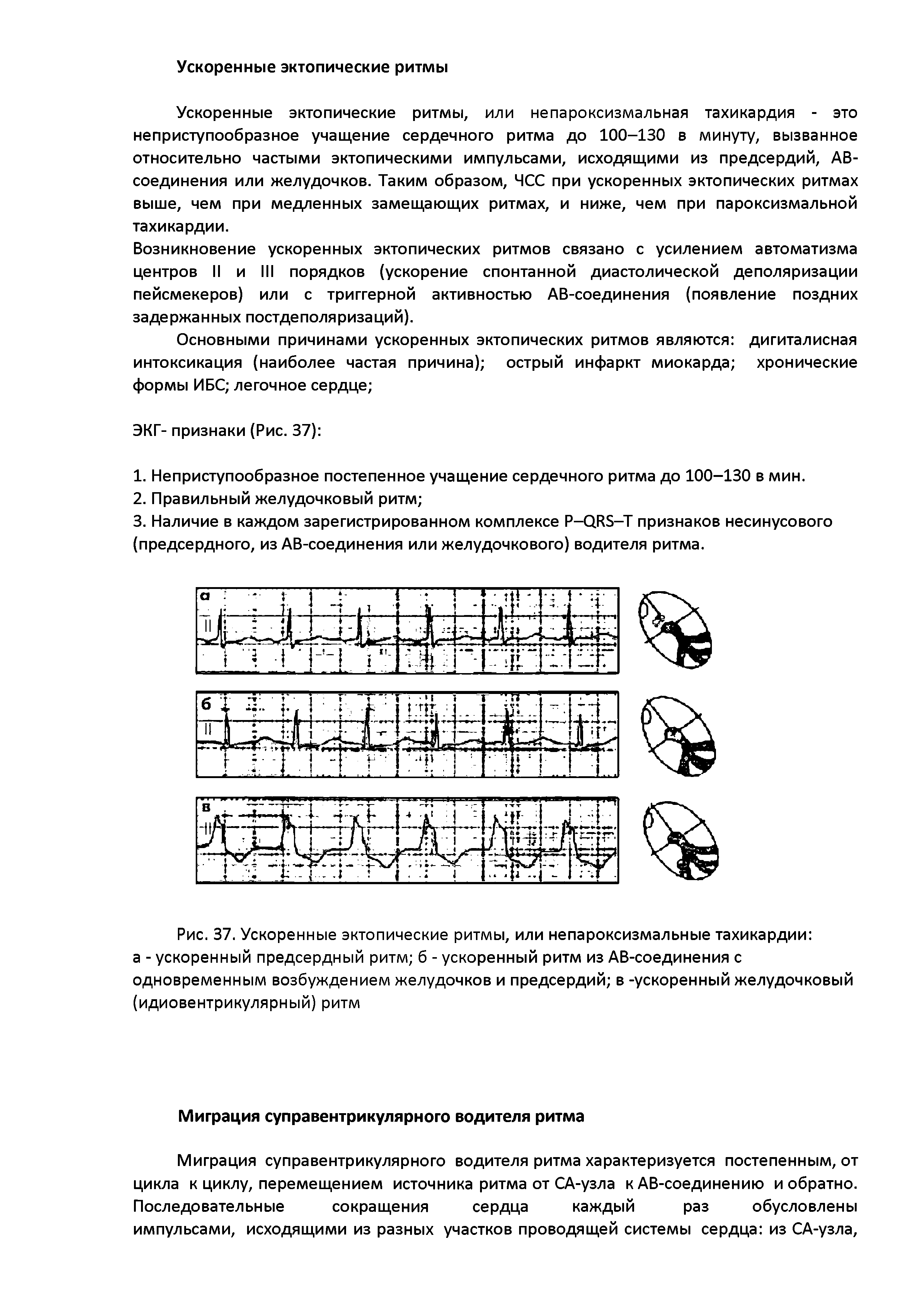 Рис. 37. Ускоренные эктопические ритмы, или непароксизмальные тахикардии а - ускоренный предсердный ритм б - ускоренный ритм из АВ-соединения с одновременным возбуждением желудочков и предсердий в -ускоренный желудочковый (идиовентрикулярный) ритм...