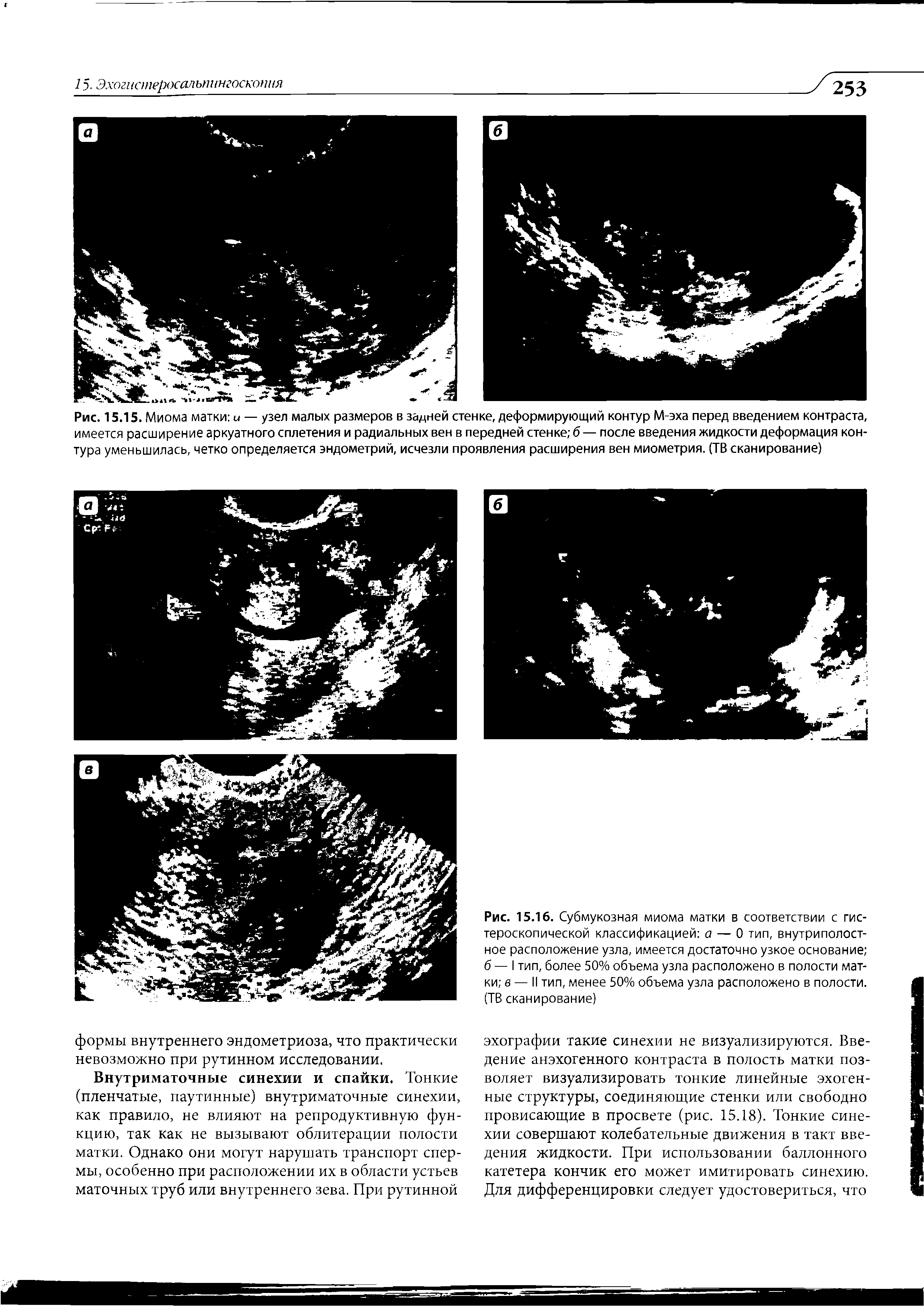 Рис. 15.16. Субмукозная миома матки в соответствии с гистероскопической классификацией а — 0 тип, внутриполост-ное расположение узла, имеется достаточно узкое основание б — I тип, более 50% объема узла расположено в полости матки в — II тип, менее 50% объема узла расположено в полости. (ТВ сканирование)...