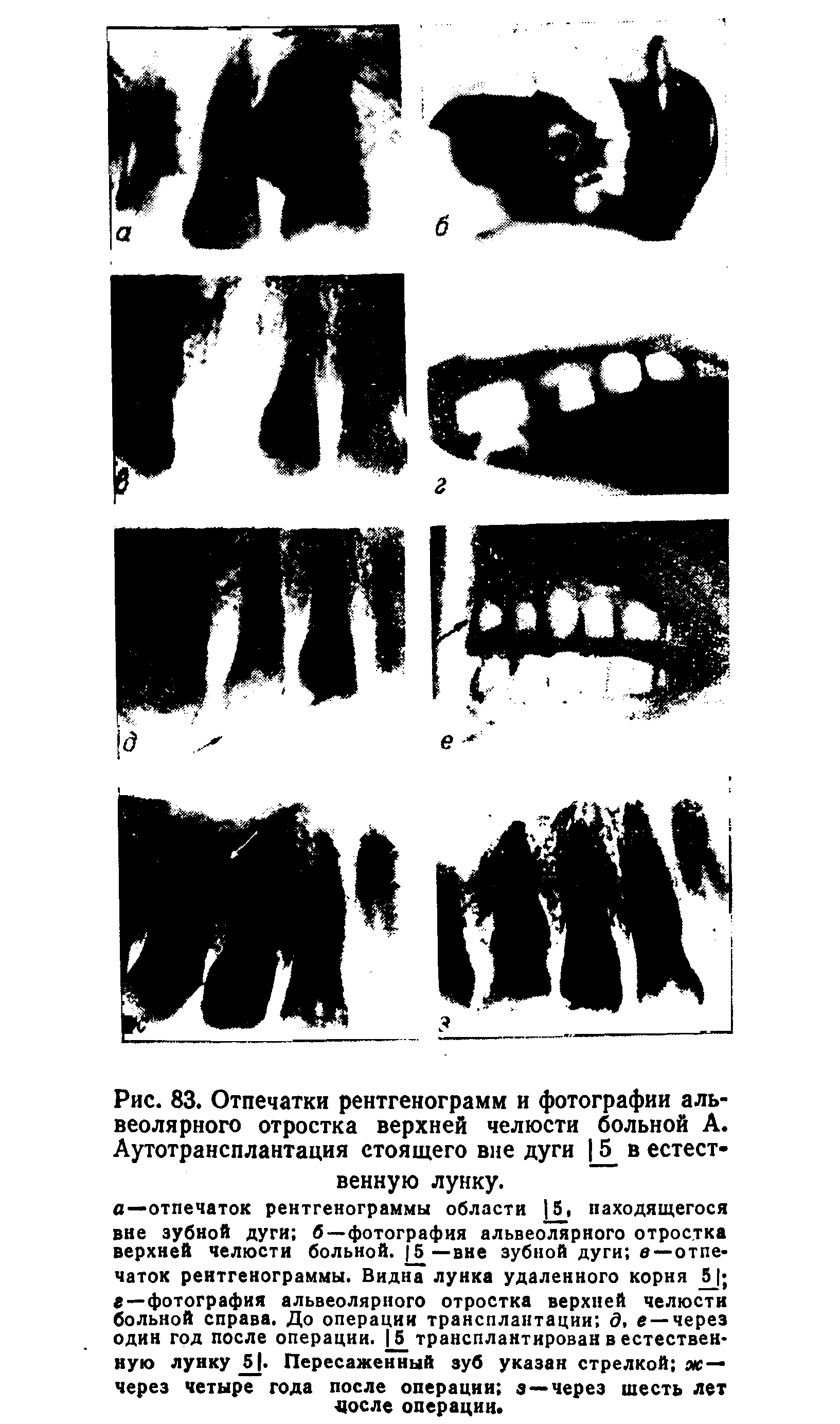 Рис. 83. Отпечатки рентгенограмм и фотографии альвеолярного отростка верхней челюсти больной А. Аутотрансплантация стоящего вне дуги 15 в естественную лунку.