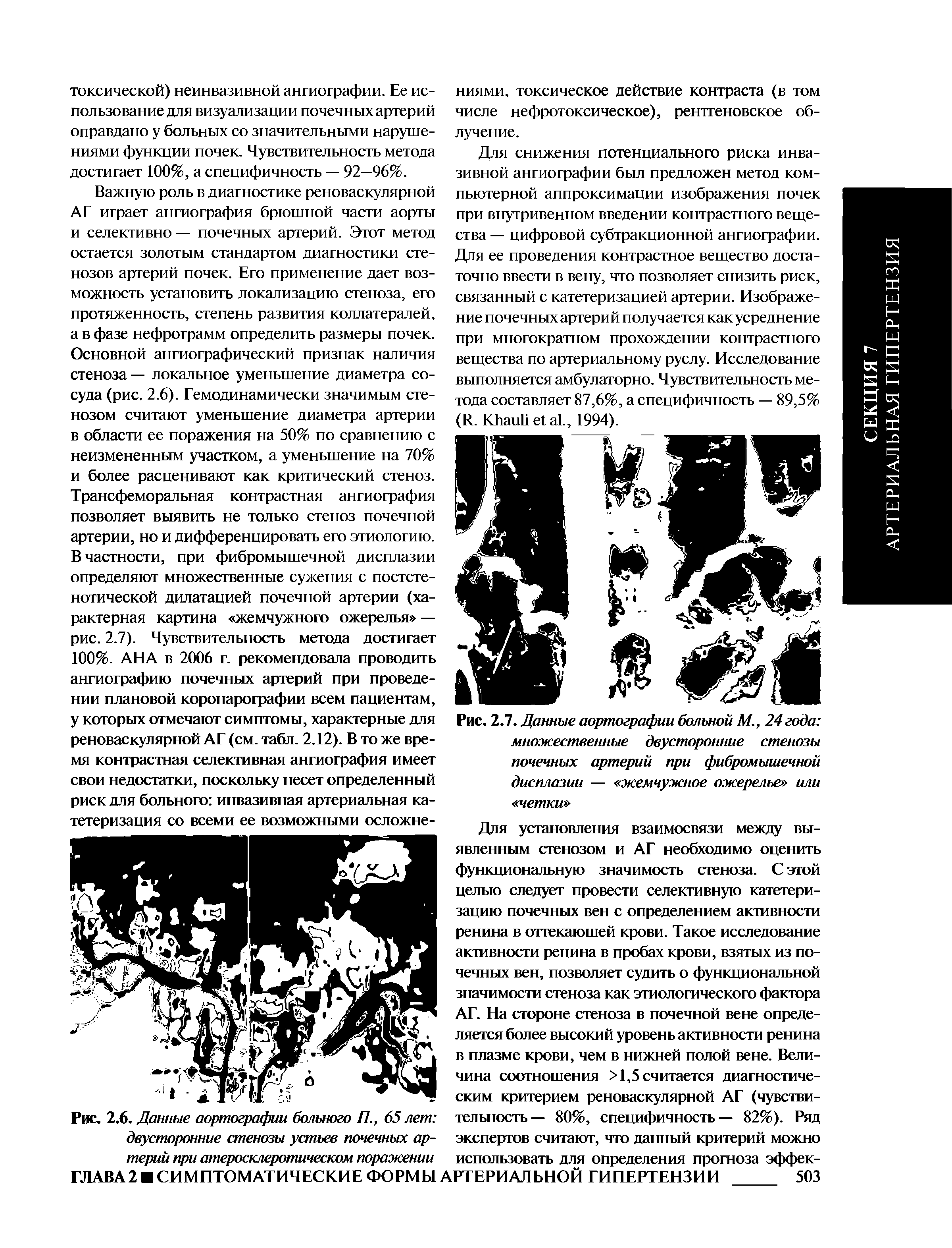 Рис. 2.7. Данные аортографии больной М., 24 года множественные двусторонние стенозы почечных артерий при фибромышечной дисплазии — жемчужное ожерелье или четки ...