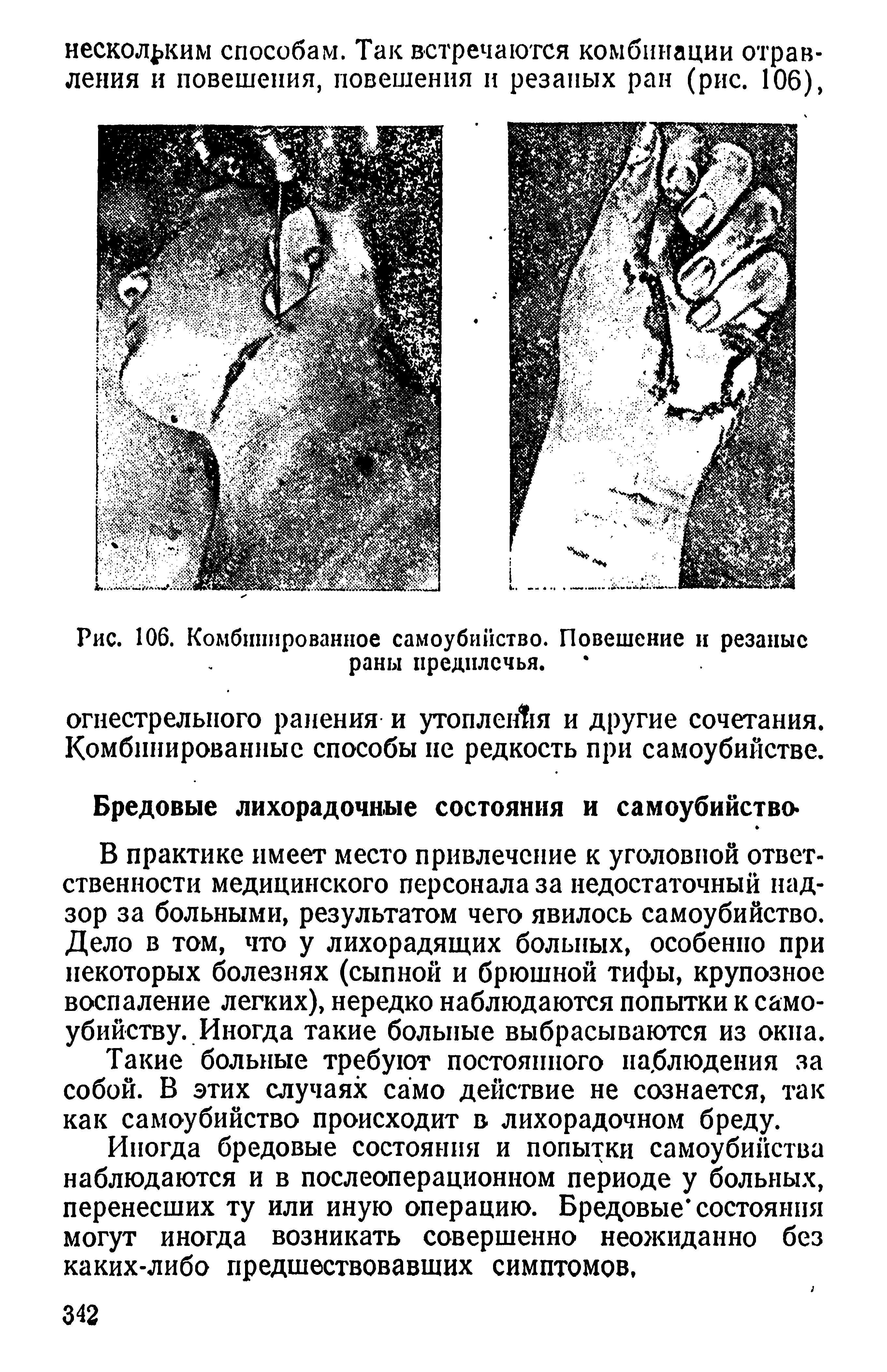 Рис. 106. Комбинированное самоубийство. Повешение и резаные раны предплечья.