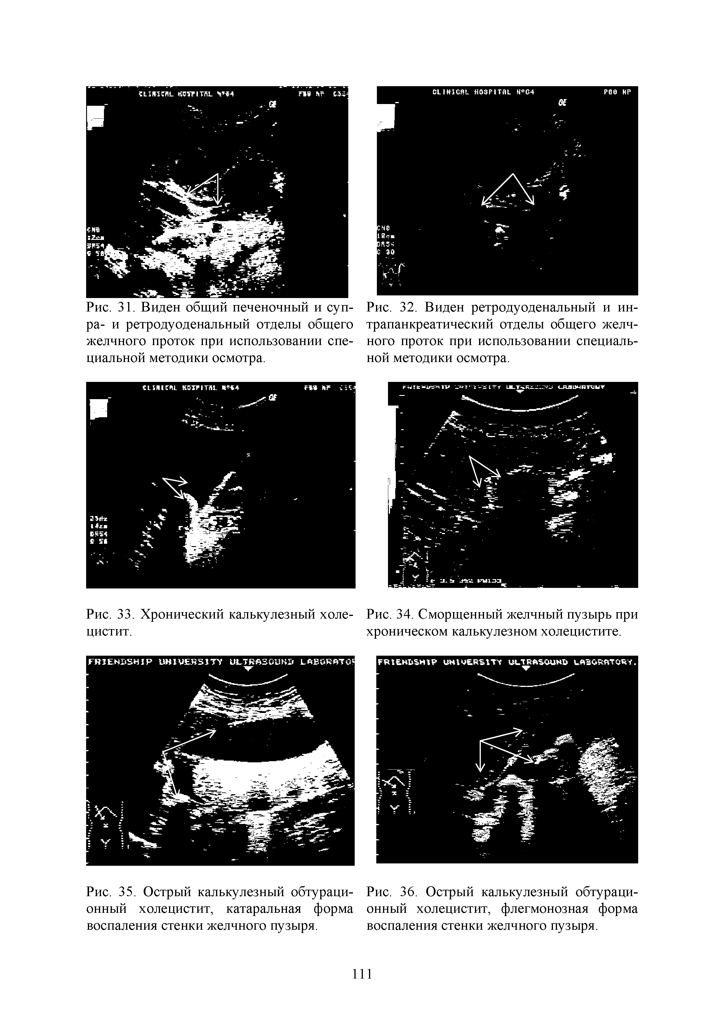 Рис. 35. Острый калькулезный обтураци- Рис. 36. Острый калькулезный обтурационный холецистит, катаральная форма онный холецистит, флегмонозная форма воспаления стенки желчного пузыря. воспаления стенки желчного пузыря.