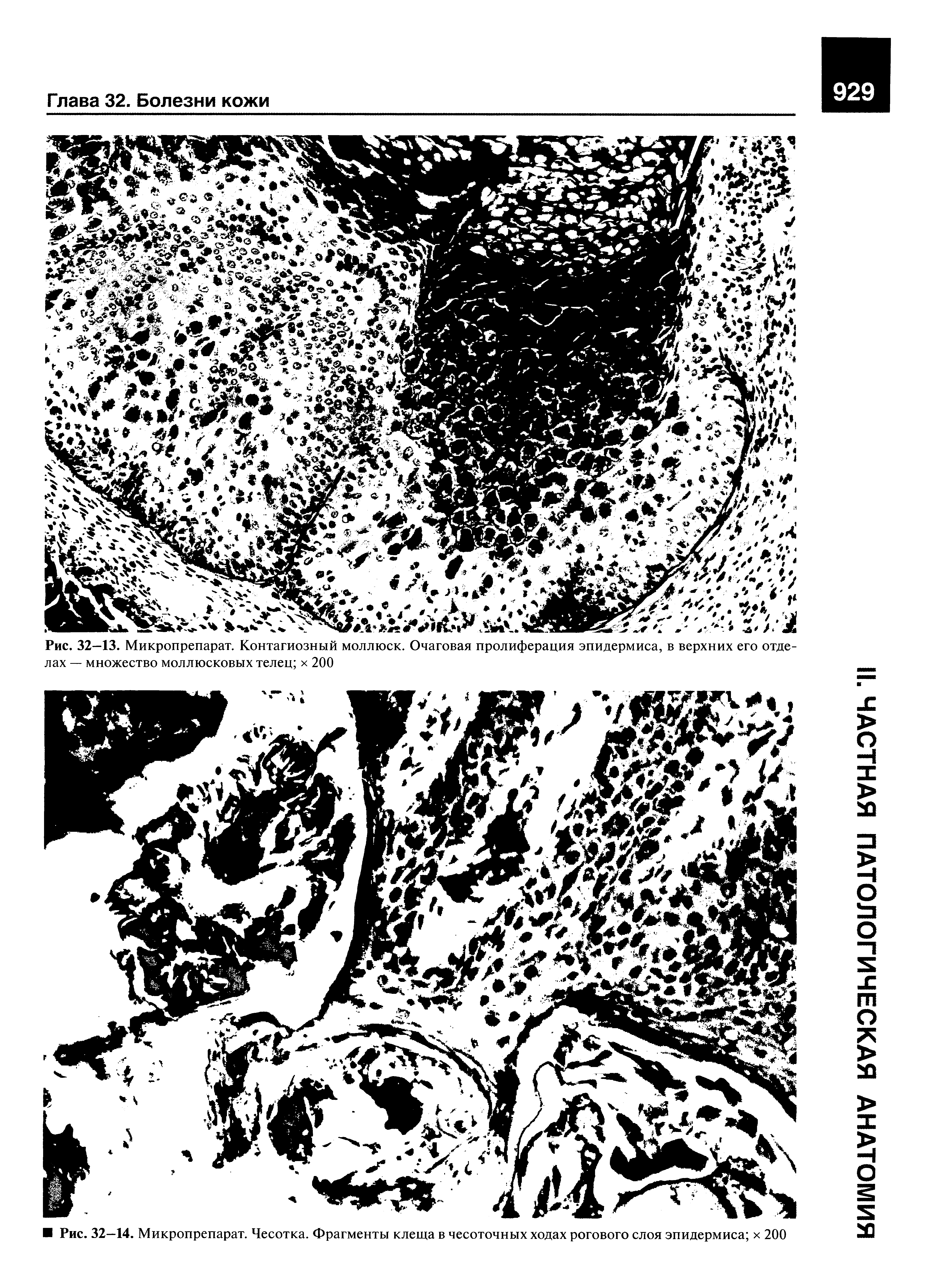 Рис. 32—13. Микропрепарат. Контагиозный моллюск. Очаговая пролиферация эпидермиса, в верхних его отделах — множество моллюсковых телец х 200...