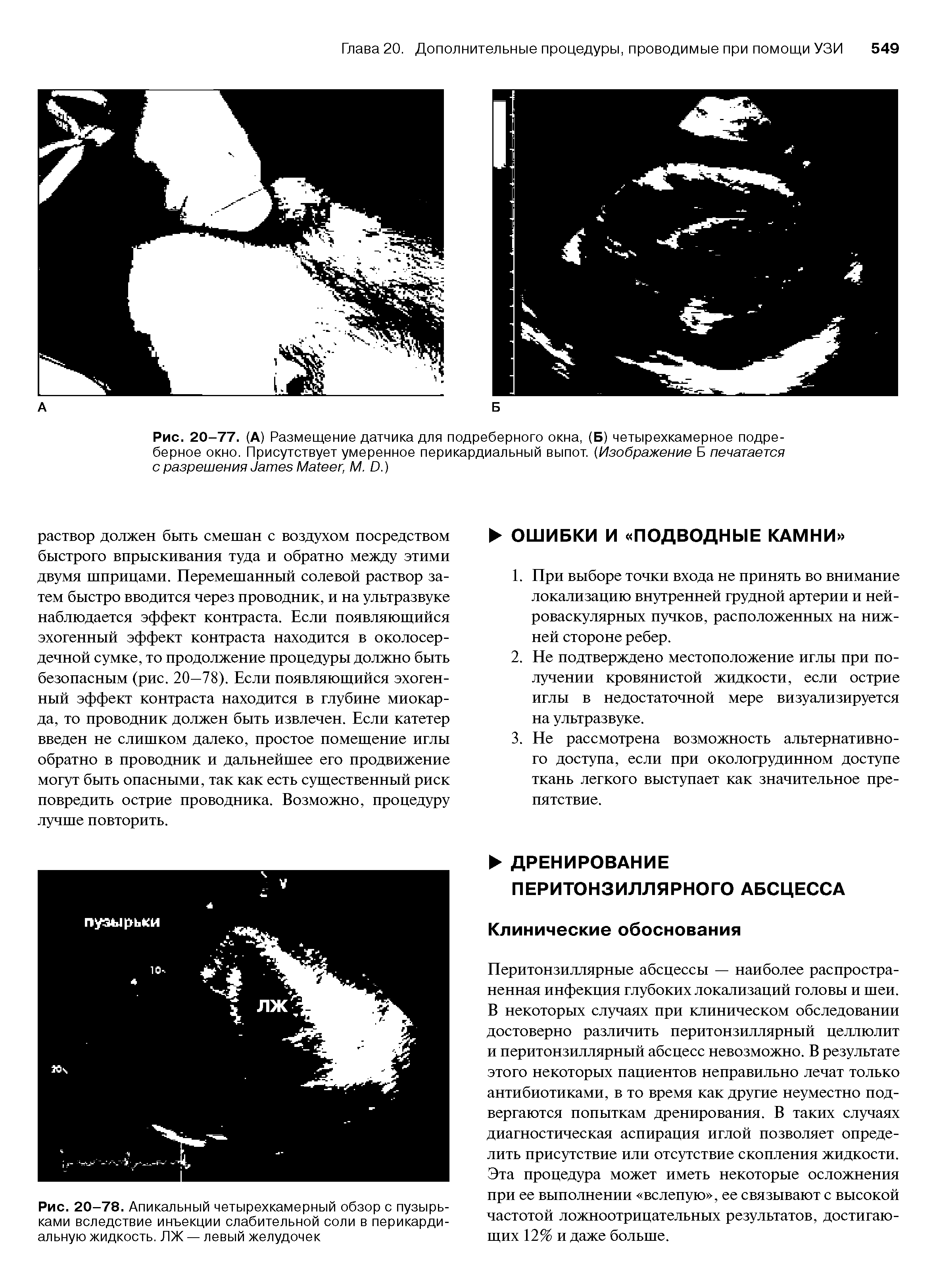 Рис. 20-77. (А) Размещение датчика для подреберного окна, (Б) четырехкамерное подреберное окно. Присутствует умеренное перикардиальный выпот. (Изображение Б печатается с разрешения тлев Ма(еег М. О. )...