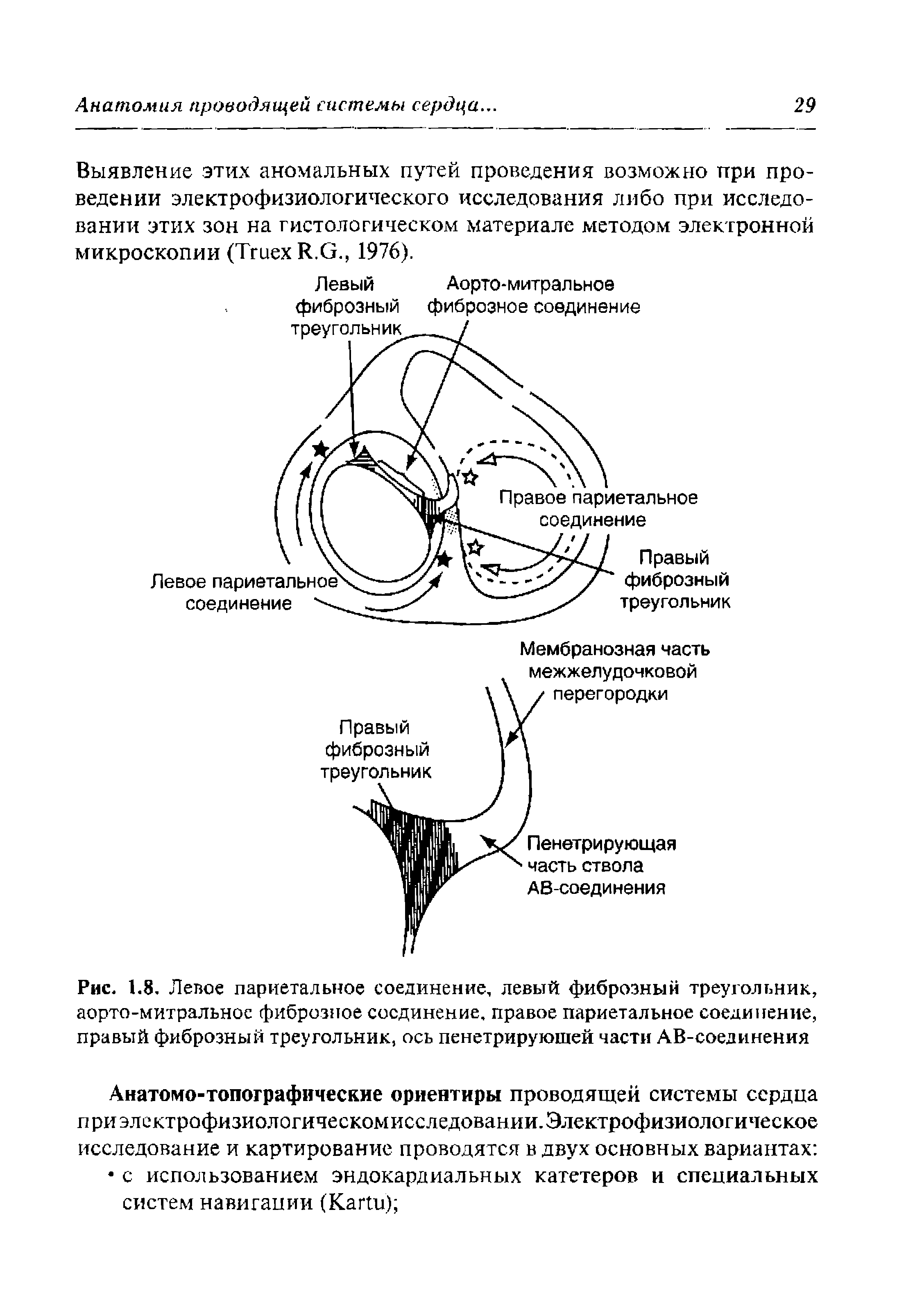 Рис. 1.8. Левое париетальное соединение, левый фиброзный треугольник, аорто-митральное фиброзное соединение, правое париетальное соединение, правый фиброзный треугольник, ось пенетрируюшей части АВ-соединения...