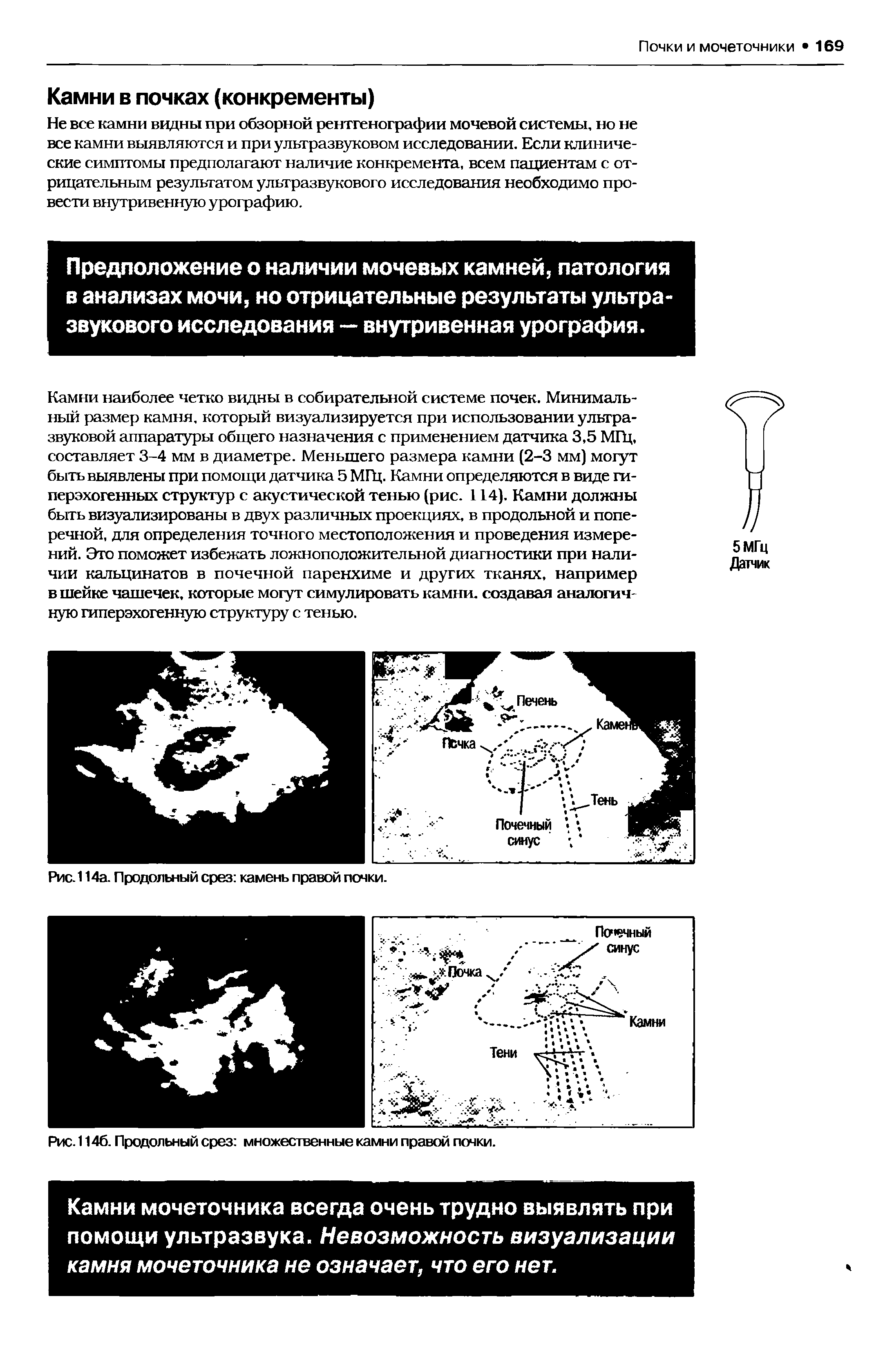 Рис. 114а. Продольный срез камень правой почки.