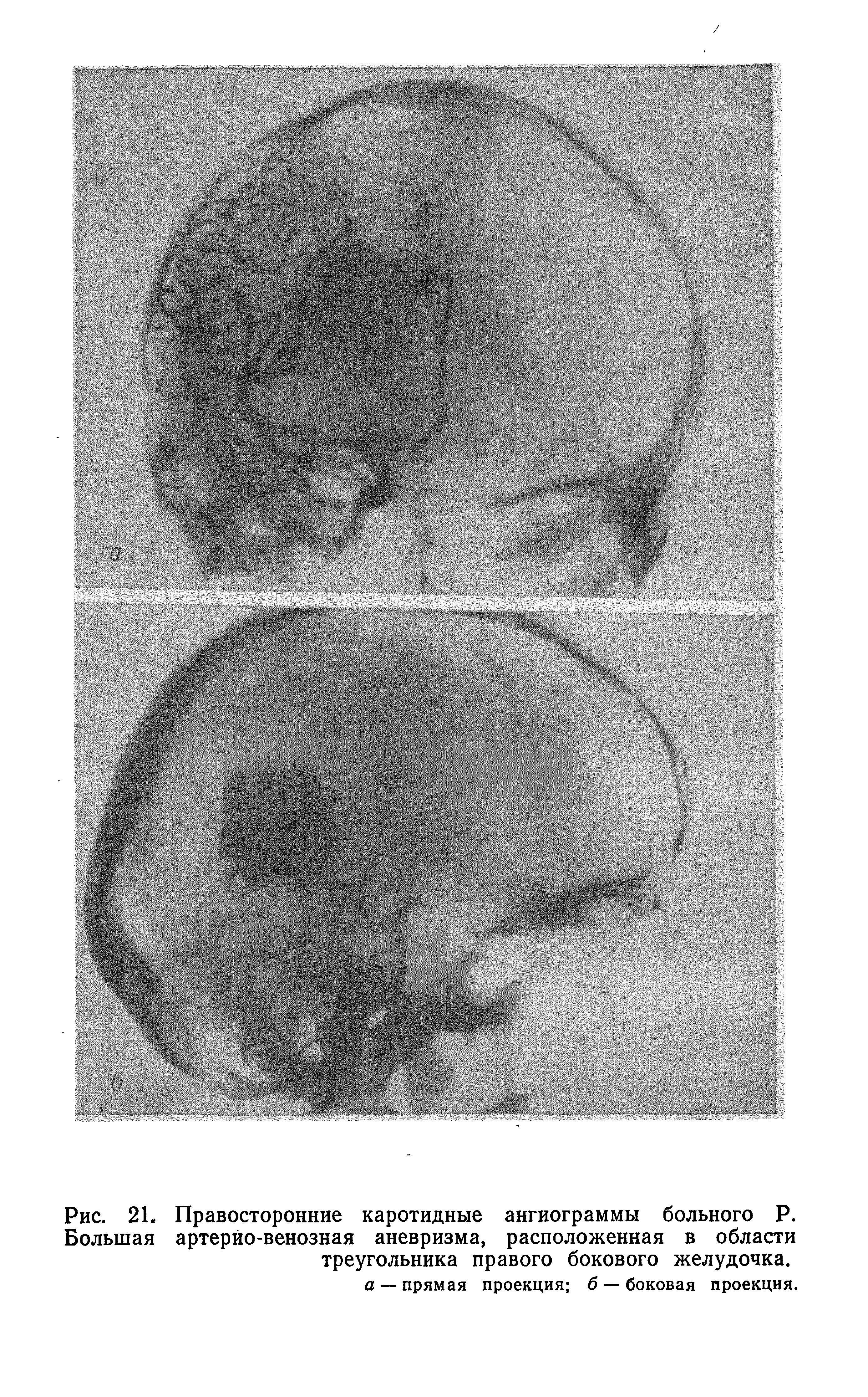 Рис. 21. Правосторонние каротидные ангиограммы больного Р. Большая артерио-венозная аневризма, расположенная в области треугольника правого бокового желудочка.