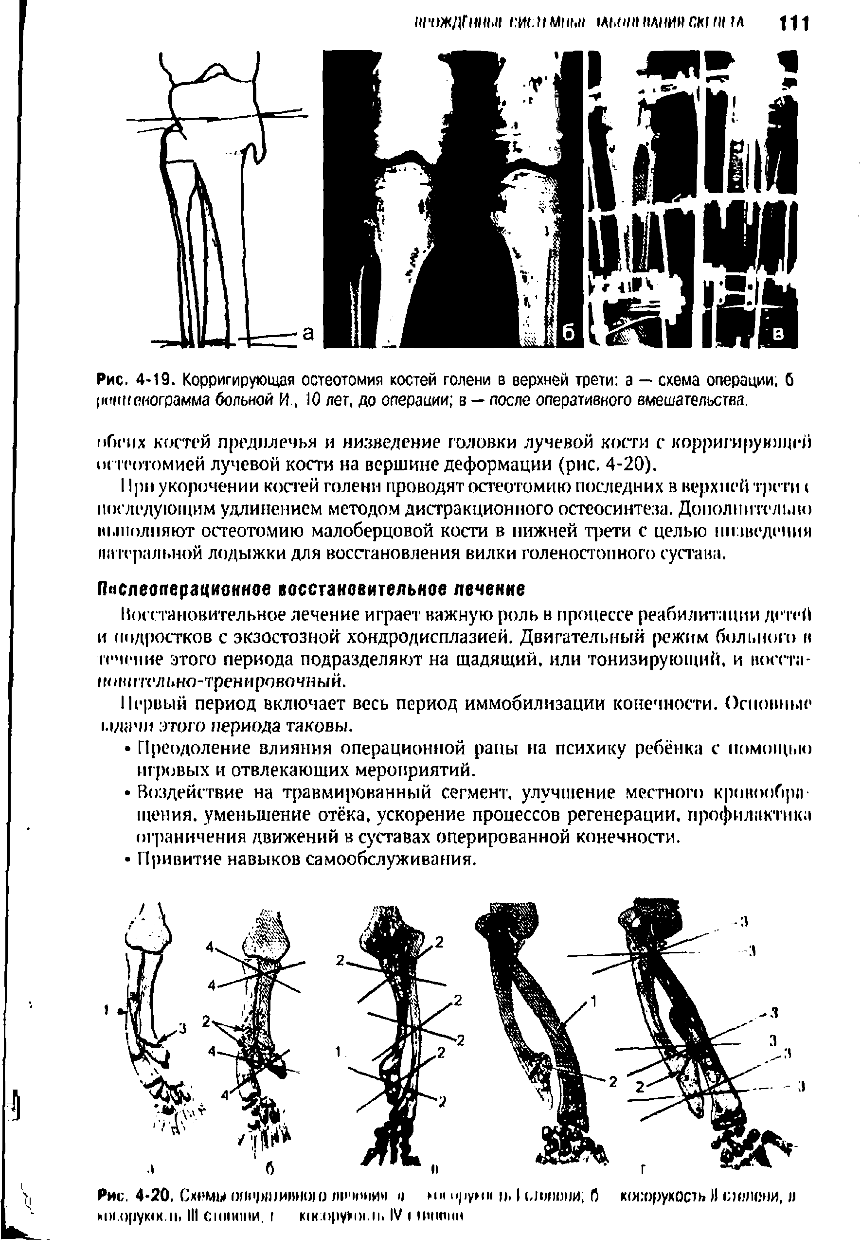 Рис. 4-19. Корригирующая остеотомия костей голени в верхней трети а — схема операции, б рсшиеиограмма больной И, 10 лет, до операции в — после оперативного вмешательства.