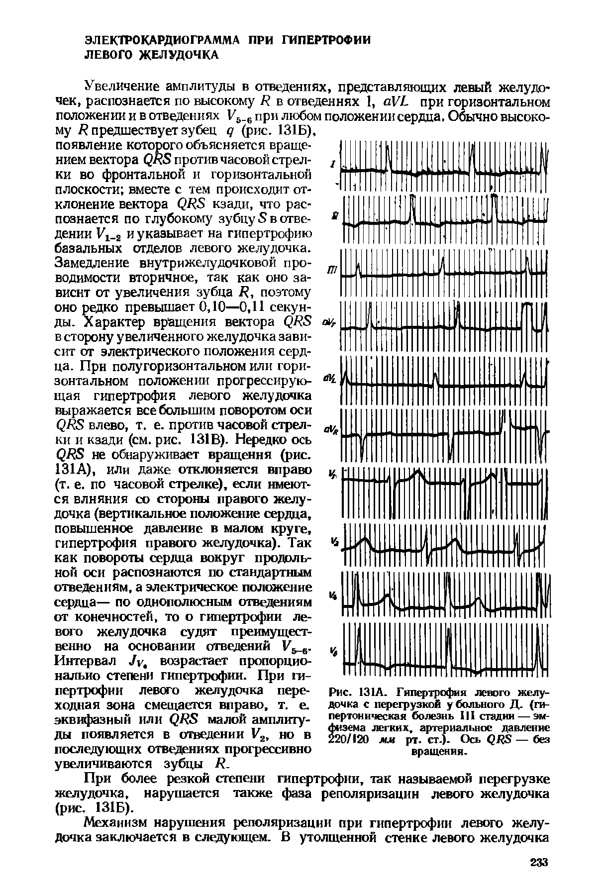 Рис. 131А. Гипертрофия левого желудочка с перегрузкой у больного Д. (гипертоническая болезнь III стадии — эмфизема легких, артериальное давление 220/120 мм рт. ст.). Ось — без вращения.