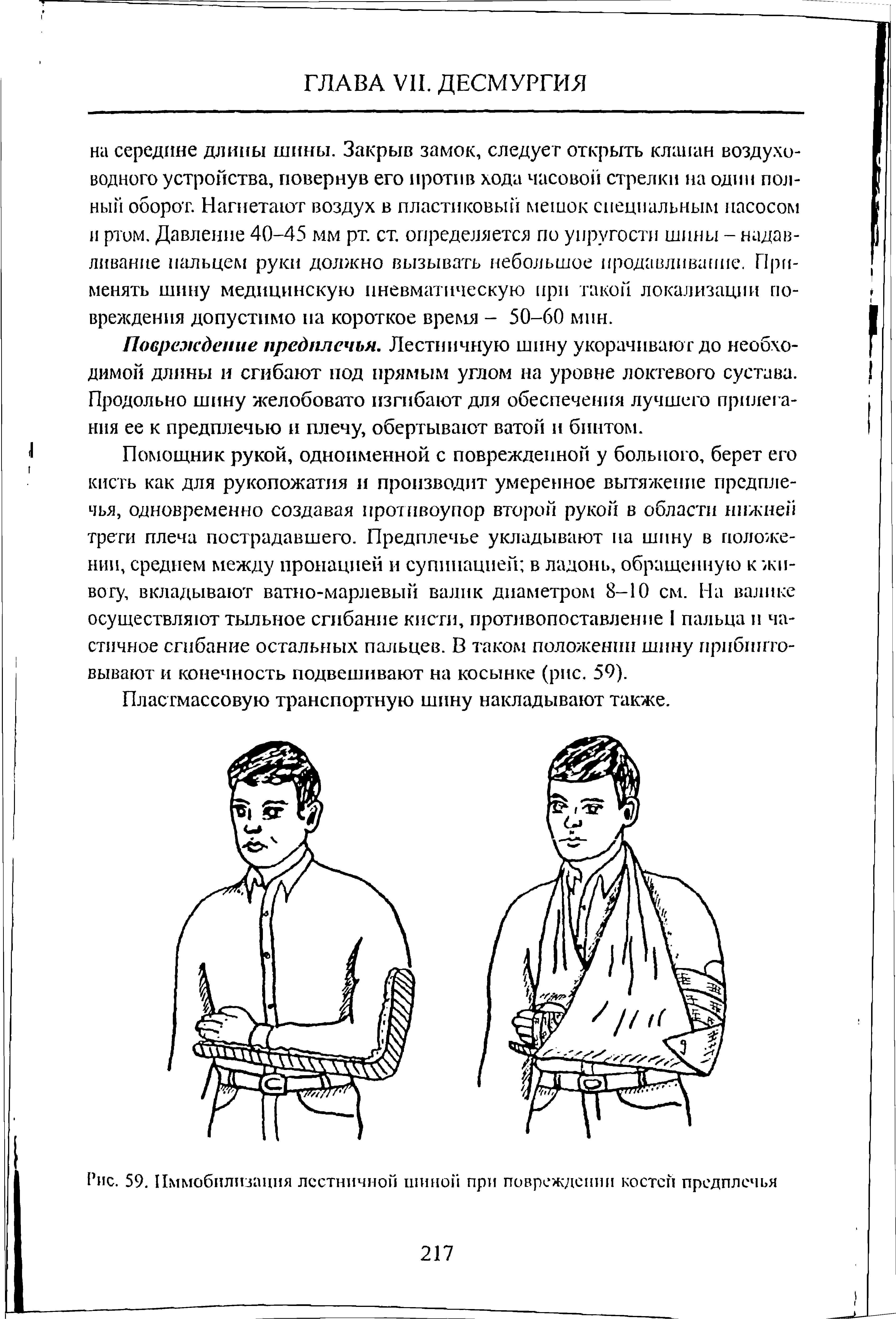 Рис. 59. Иммобилизация лестничной шиной при повреждении костей предплечья...