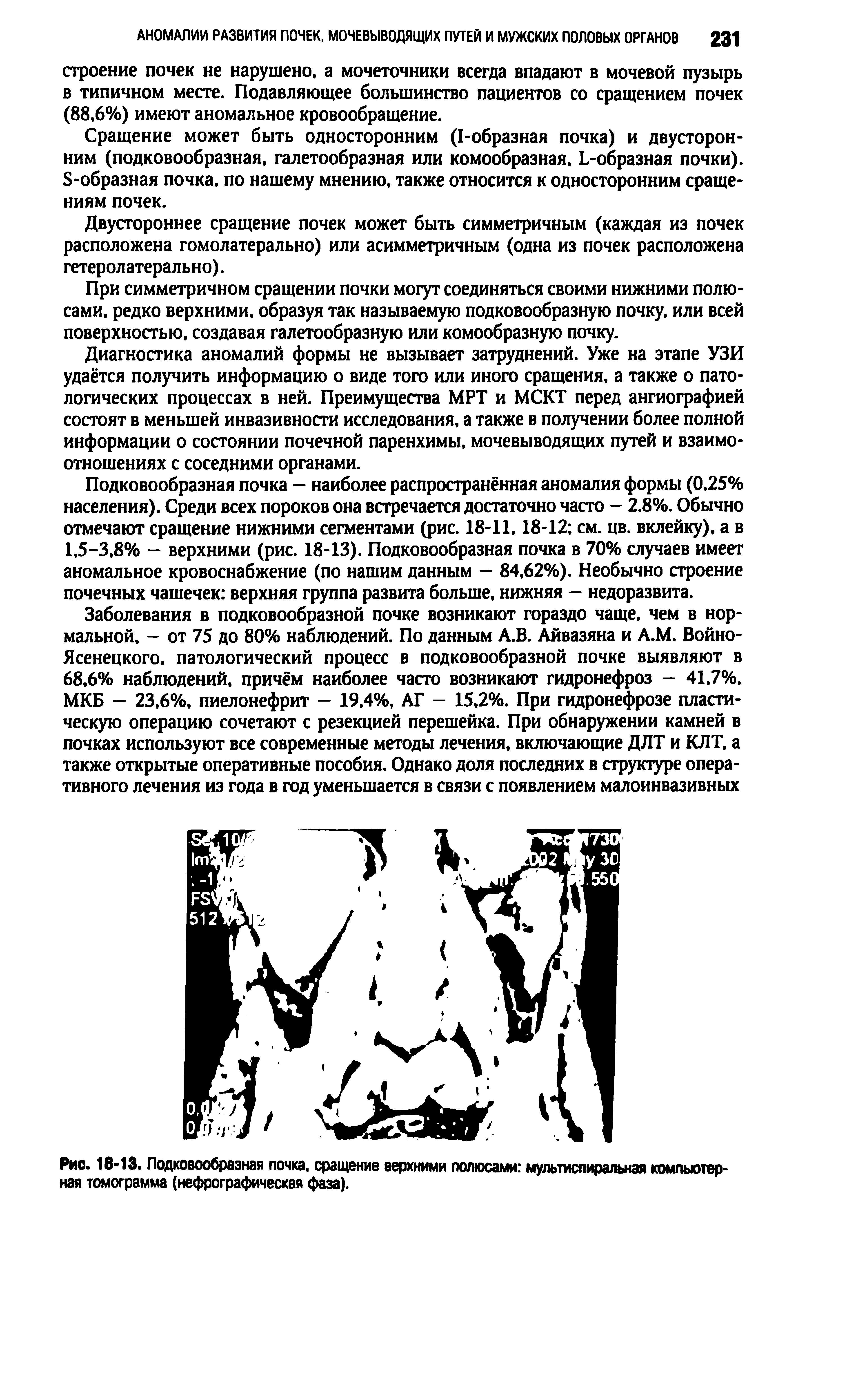 Рис. 18-13. Подковообразная почка, сращение верхними полюсами мультиспиральная компьютерная томограмма (нефрографическая фаза).