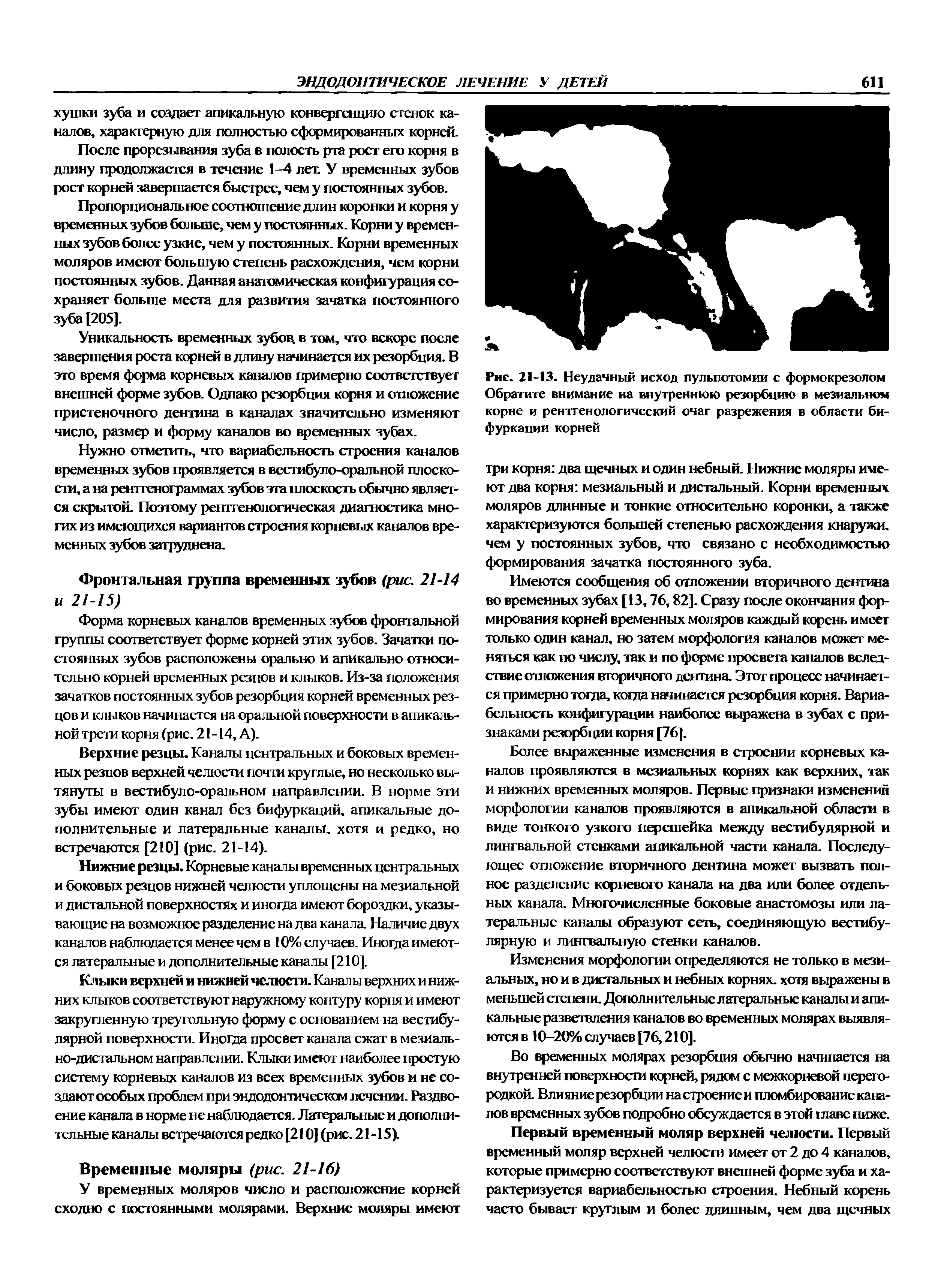 Рис. 21-13. Неудачный исход пульпотомии с формокрезолом Обратите внимание на внутреннюю резорбцию в мезиальном корне и рентгенологический очаг разрежения в области бифуркации корней...