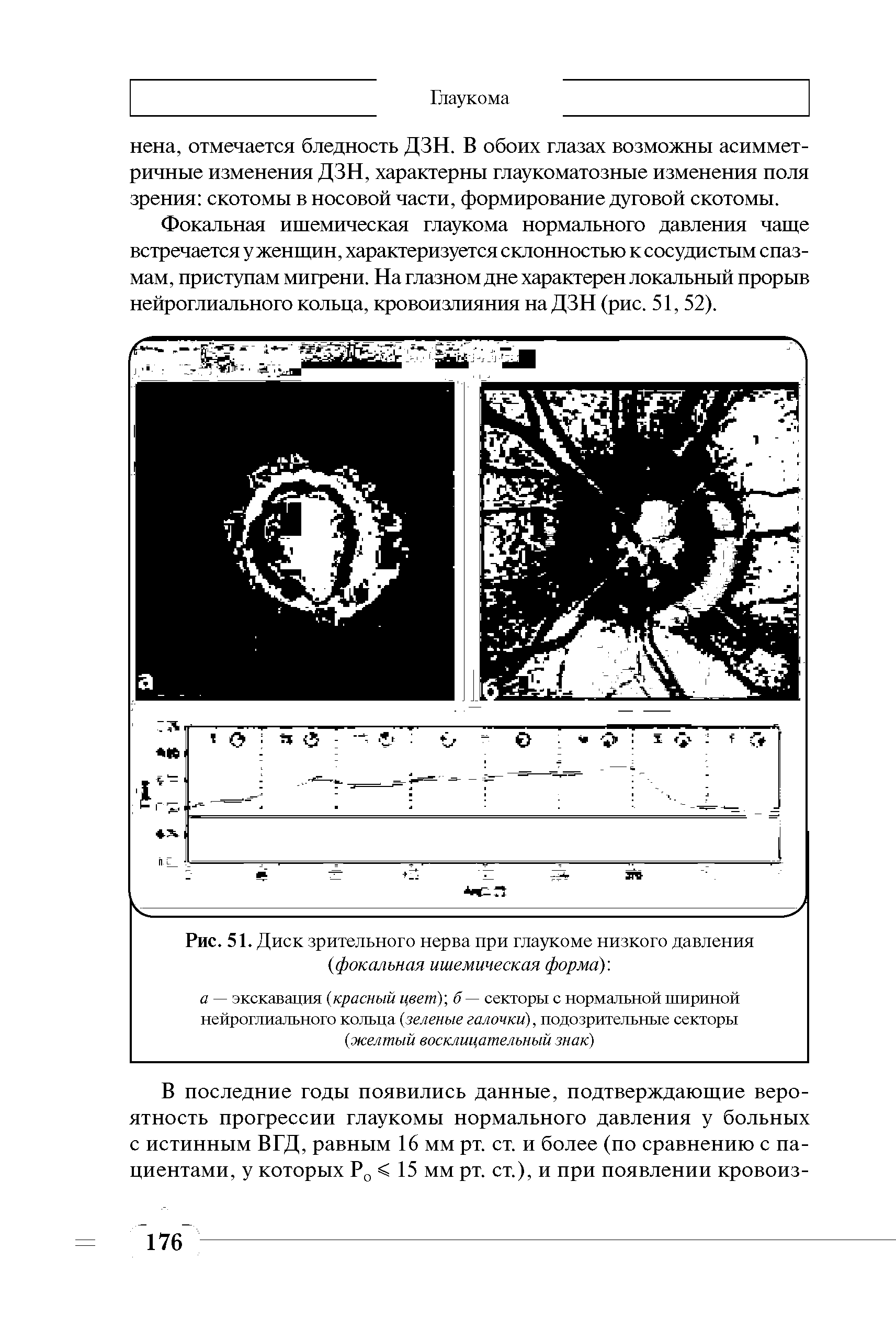 Рис. 51. Диск зрительного нерва при глаукоме низкого давления ...