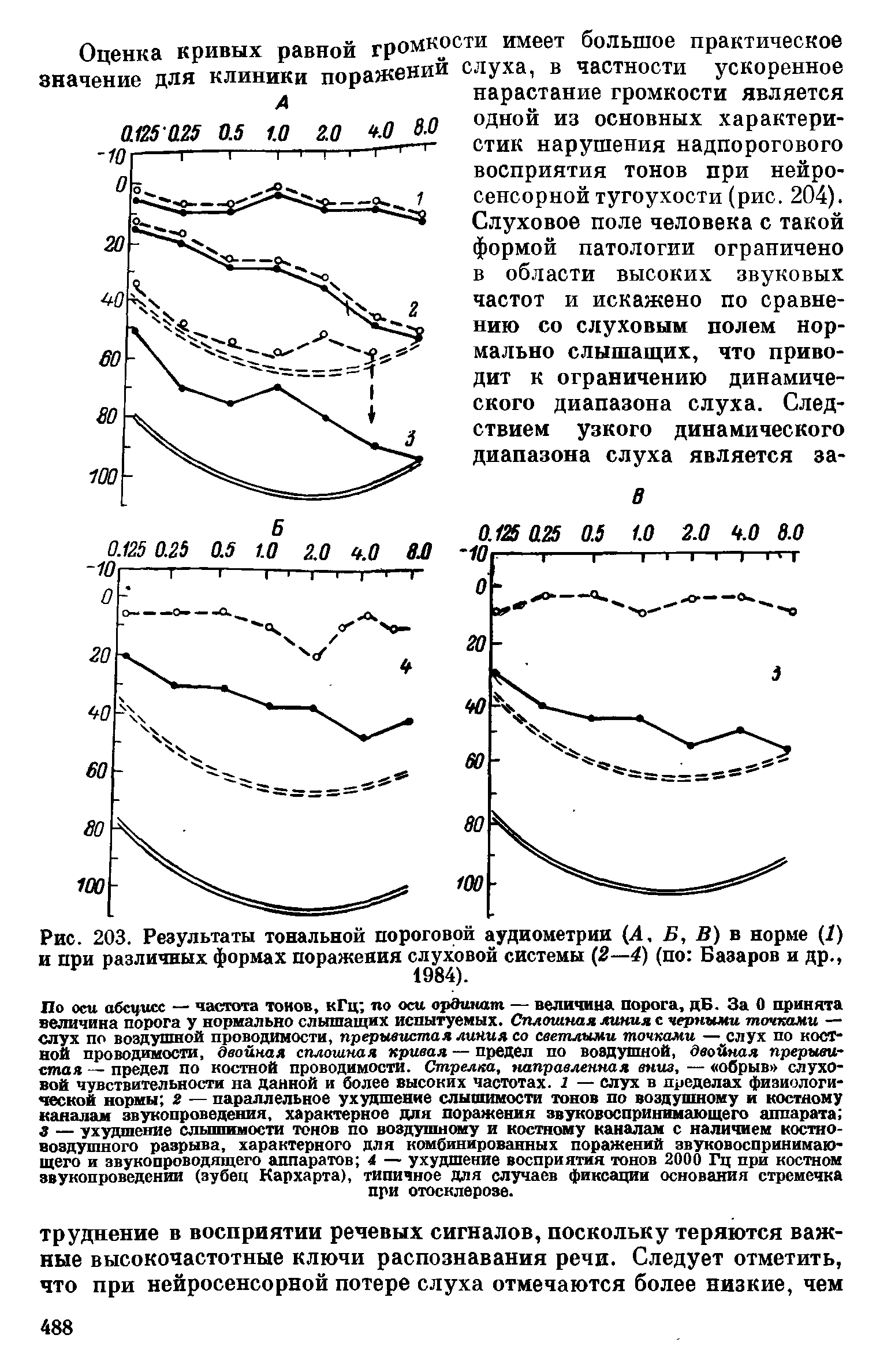 Рис. 203. Результаты тональной пороговой аудиометрии (Л, Б, В) в норме (I) и при различных формах поражения слуховой системы (2—4) (по Базаров и др.,...