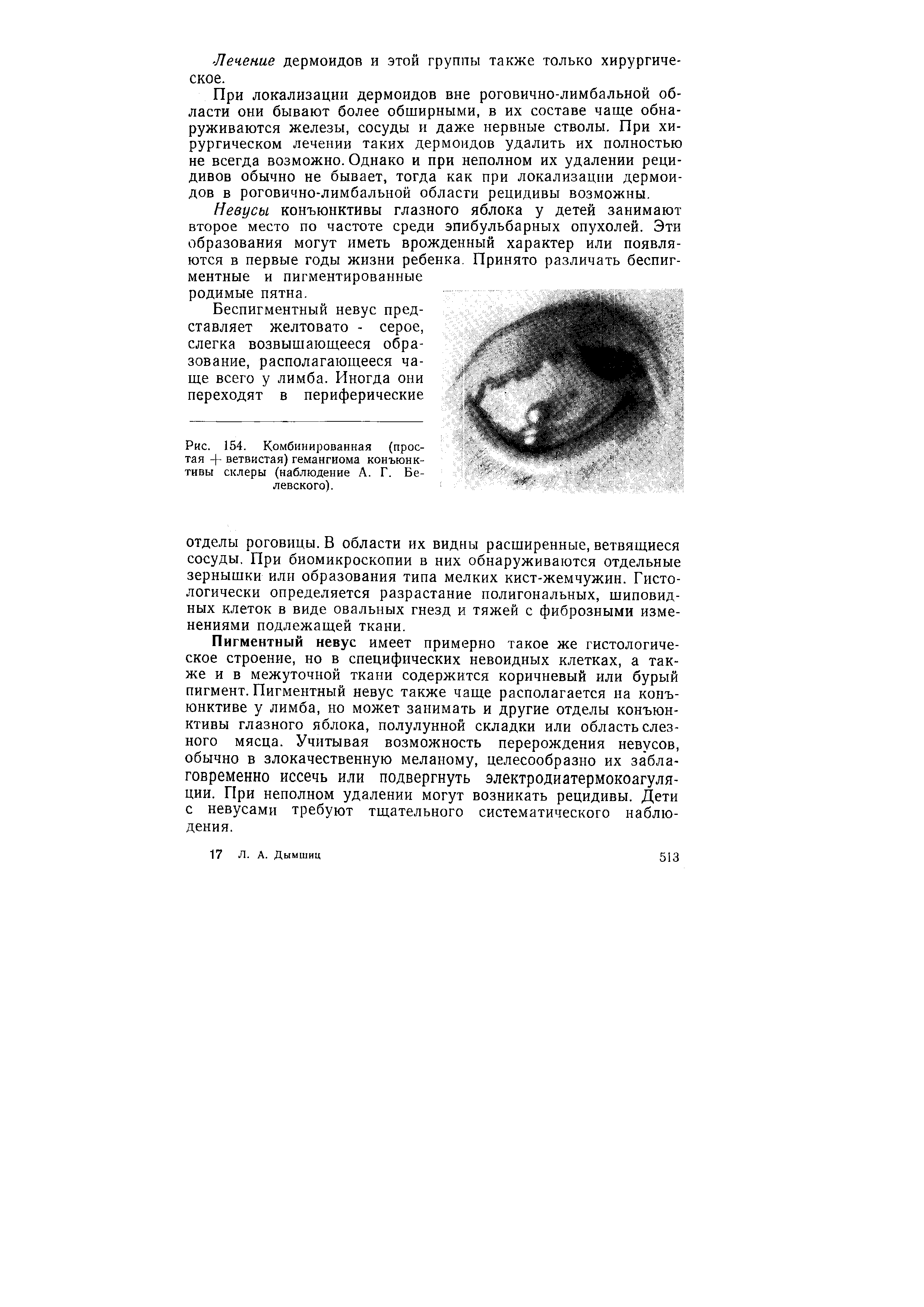 Рис. 154. Комбинированная (простая - - ветвистая) гемангиома конъюнктивы склеры (наблюдение А. Г. Белевского).