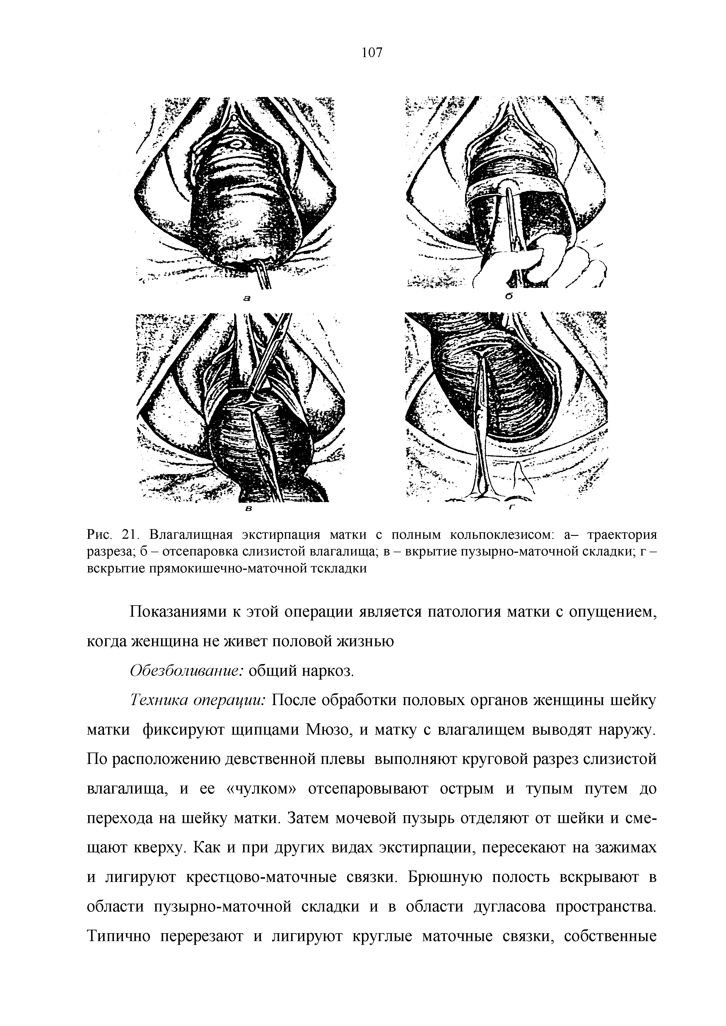 Рис. 21. Влагалищная экстирпация матки с разреза б - отсепаровка слизистой влагалища вскрытие прямокишечно-маточной тскладки...