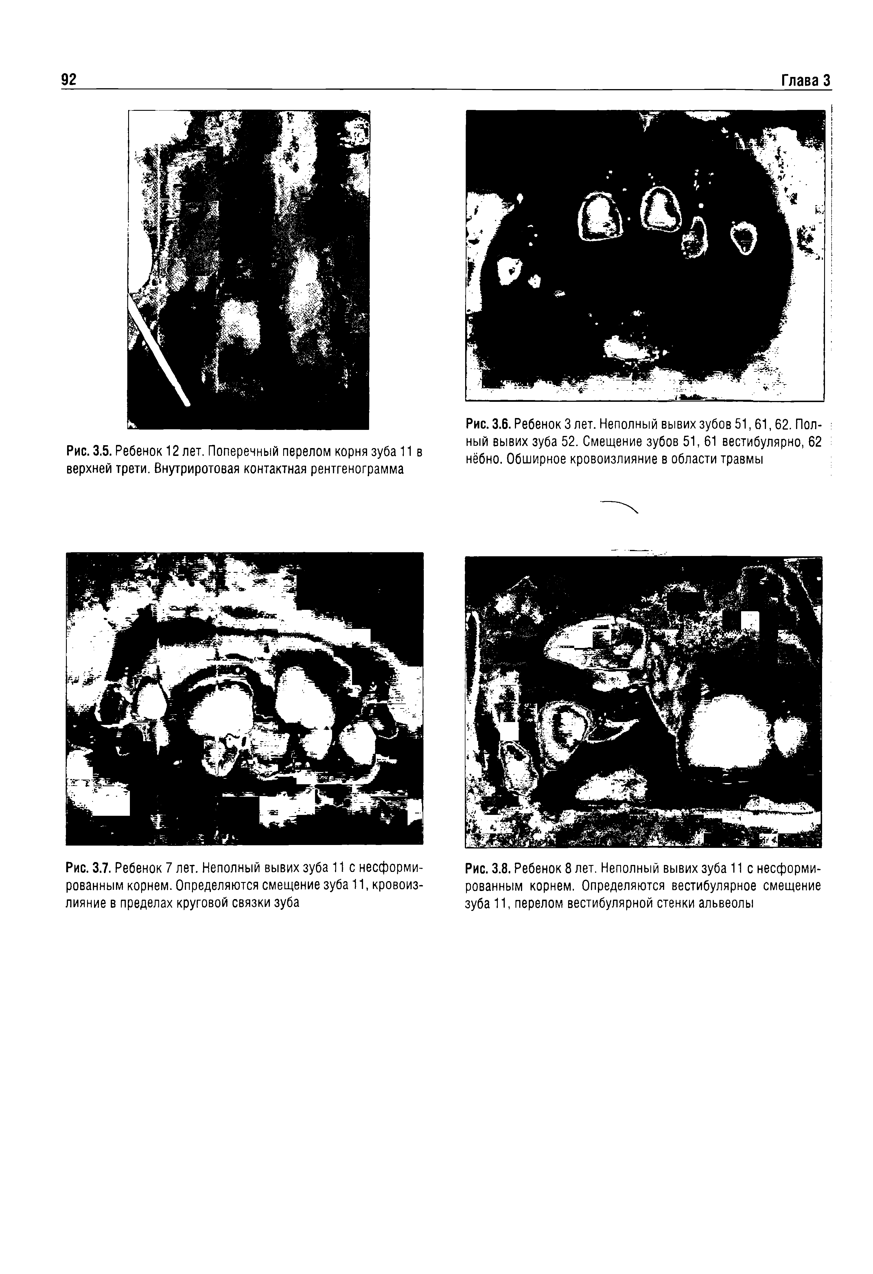 Рис. 3.6. Ребенок 3 лет. Неполный вывих зубов 51,61,62. Полный вывих зуба 52. Смещение зубов 51, 61 вестибулярно, 62 нёбно. Обширное кровоизлияние в области травмы...