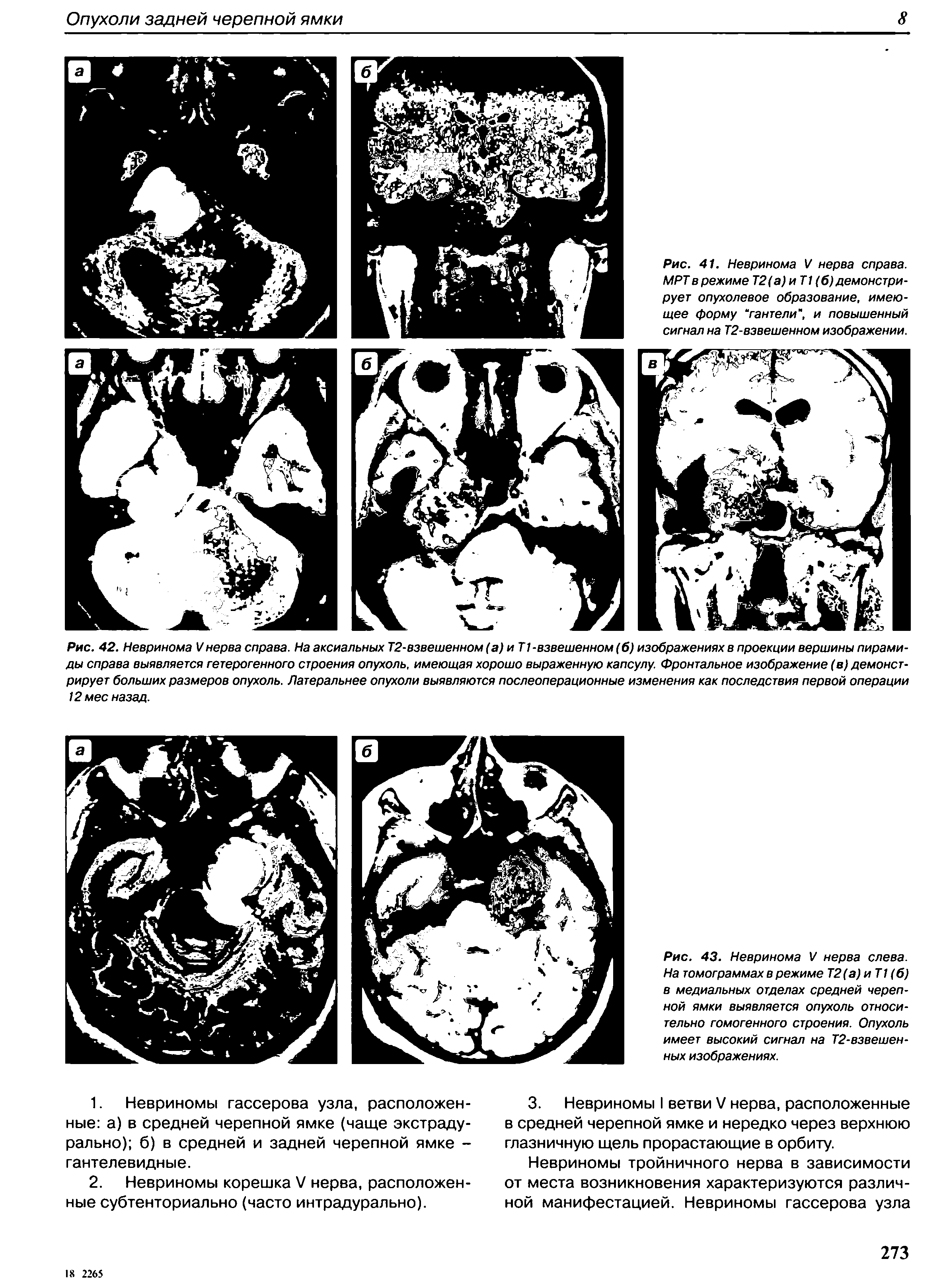 Рис. 43. Невринома V нерва слева. На томограммах в режиме Т2(а) иТ1 (б) в медиальных отделах средней черепной ямки выявляется опухоль относительно гомогенного строения. Опухоль имеет высокий сигнал на Т2-взвешен-ных изображениях.