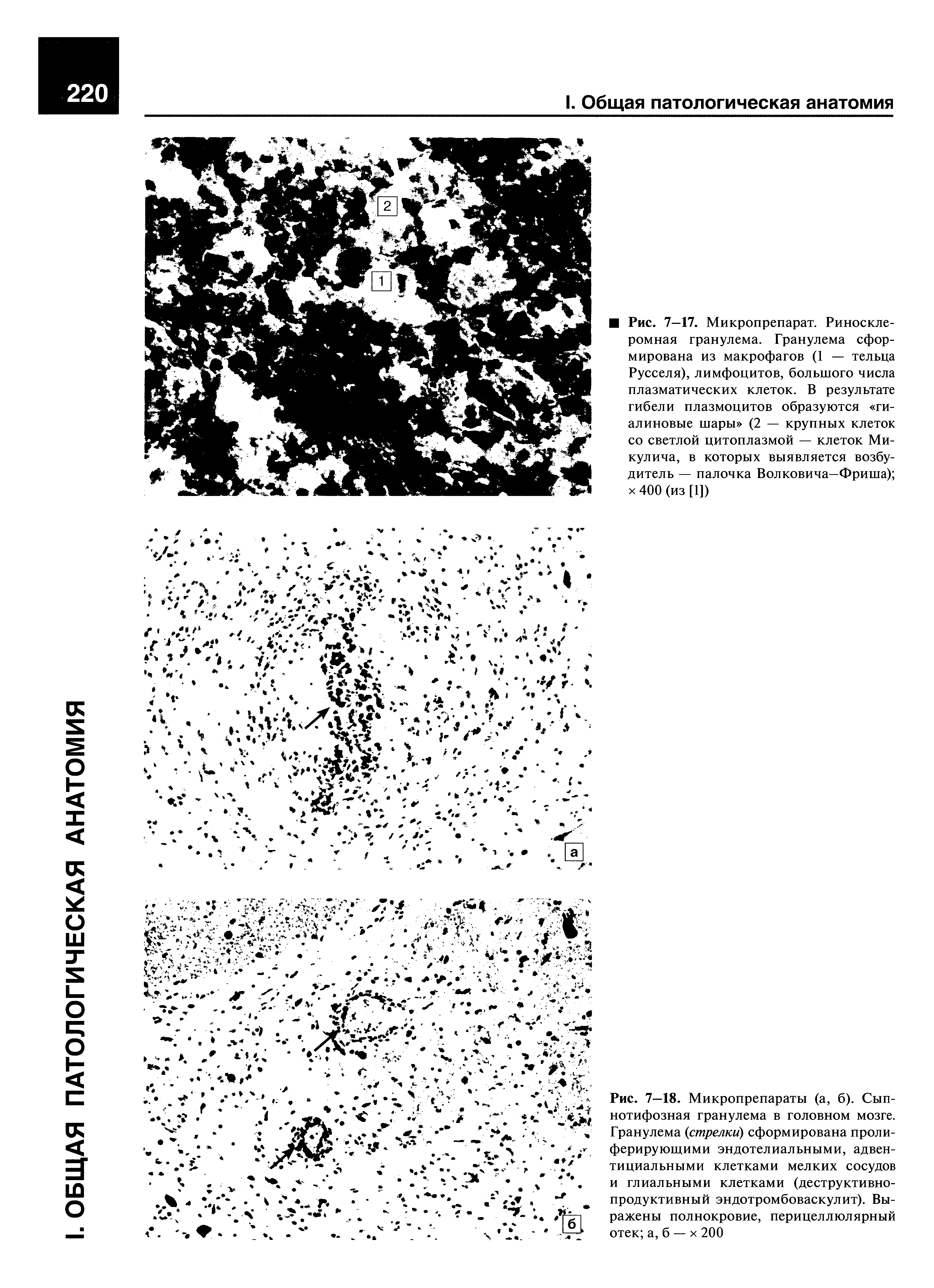 Рис. 7—18. Микропрепараты (а, б). Сыпнотифозная гранулема в головном мозге. Гранулема (стрелки) сформирована пролиферирующими эндотелиальными, адвентициальными клетками мелких сосудов и глиальными клетками (деструктивнопродуктивный эндотромбоваскулит). Выражены полнокровие, перицеллюлярный отек а, б — х 200...