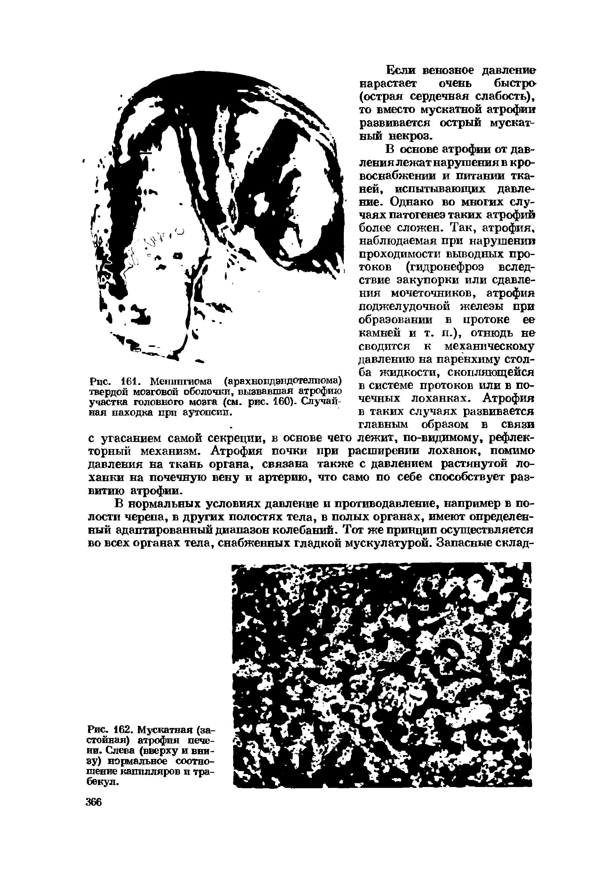 Рис. 162. Мускатная (застойная) атрофия печени. Слева (вверху и внизу) нормальное соотношение капилляров и трабекул.