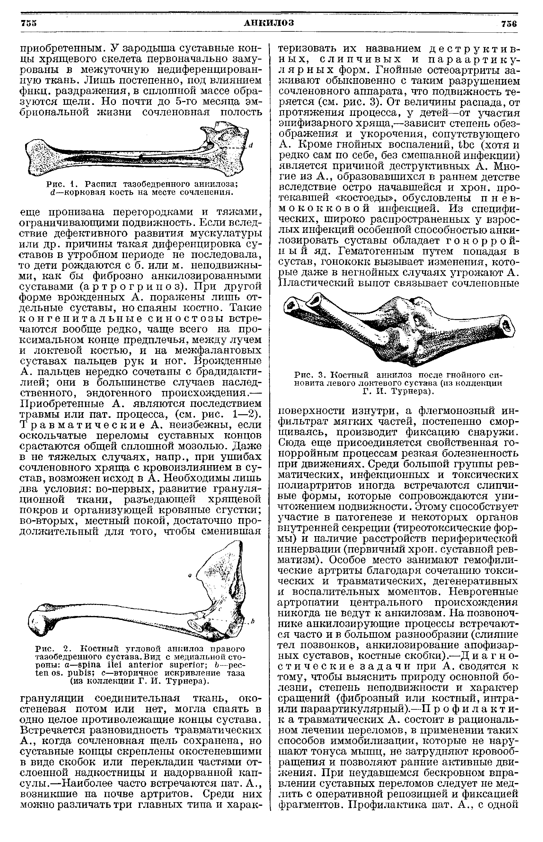 Рис. 1. Распил тазобедренного анкилоза <7—корковая кость на месте сочленения.