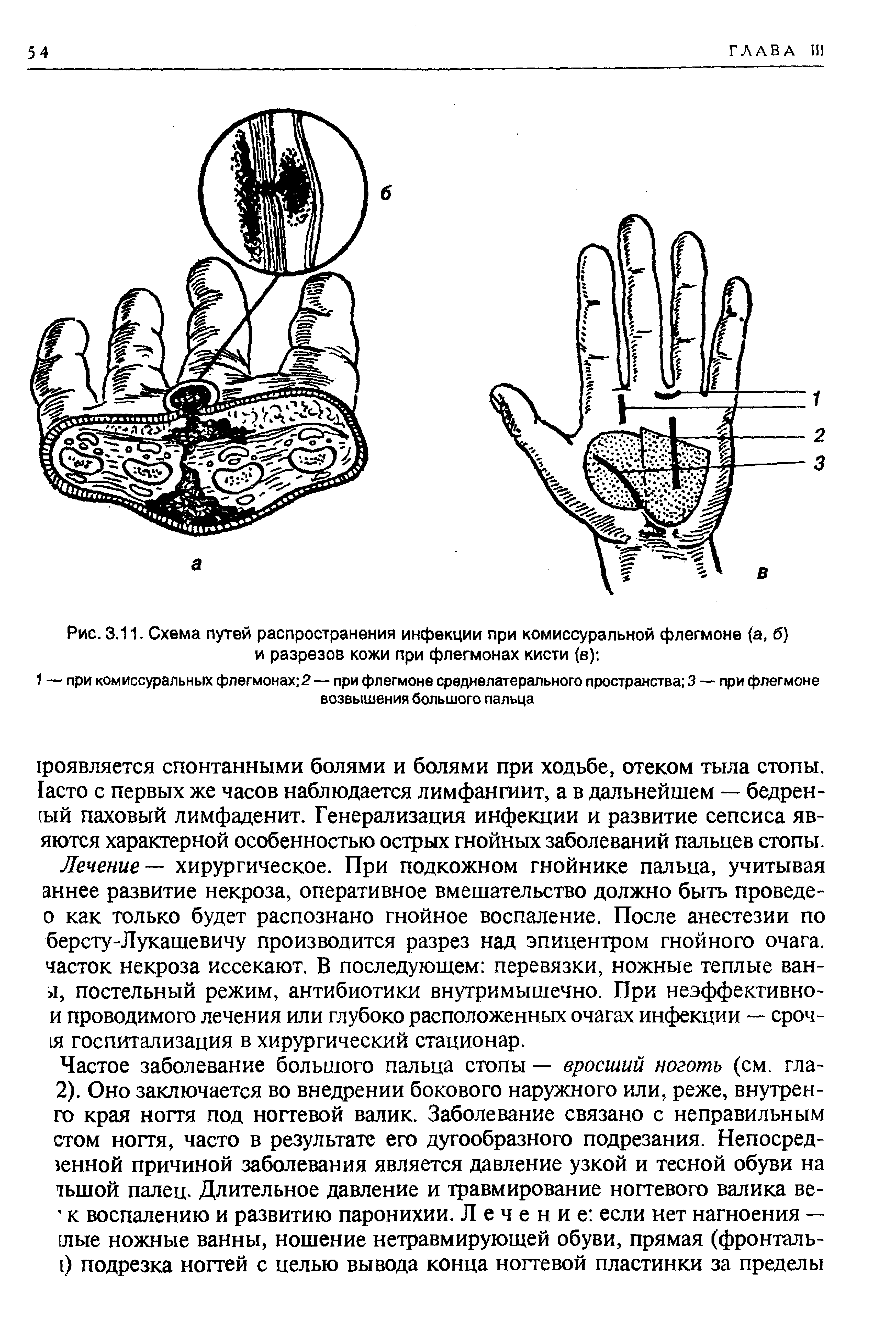 Рис. 3.11. Схема путей распространения инфекции при комиссуральной флегмоне (а, б) и разрезов кожи при флегмонах кисти (в) ...