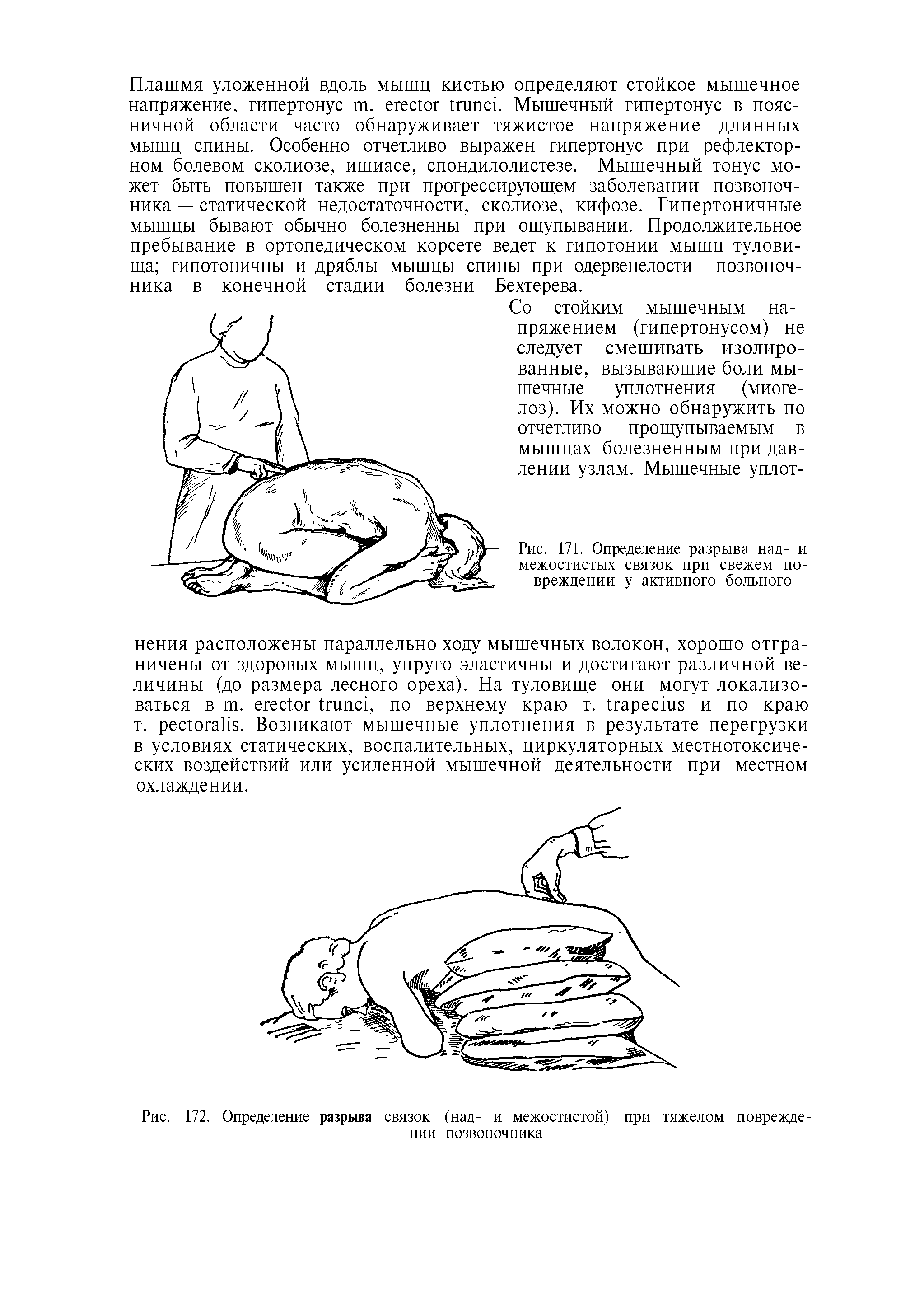 Рис. 171. Определение разрыва над- и межостистых связок при свежем повреждении у активного больного...