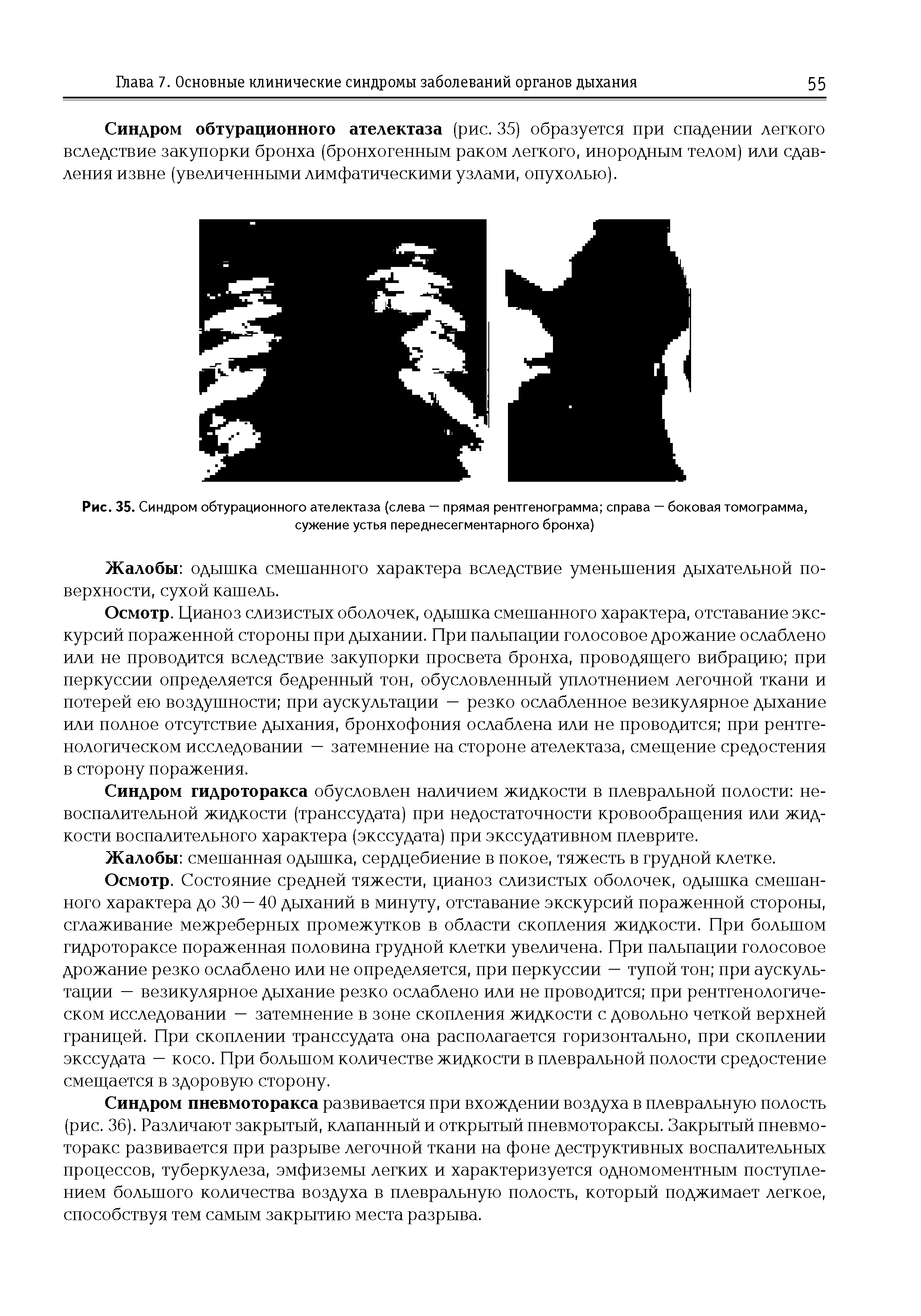 Рис. 35. Синдром обтурационного ателектаза (слева — прямая рентгенограмма справа — боковая томограмма, сужение устья переднесегментарного бронха)...