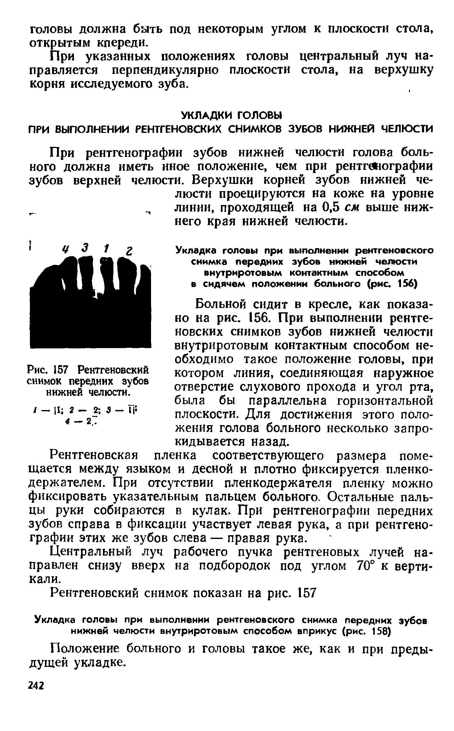 Рис. 57 Рентгеновский снимок передних зубов нижней челюсти.