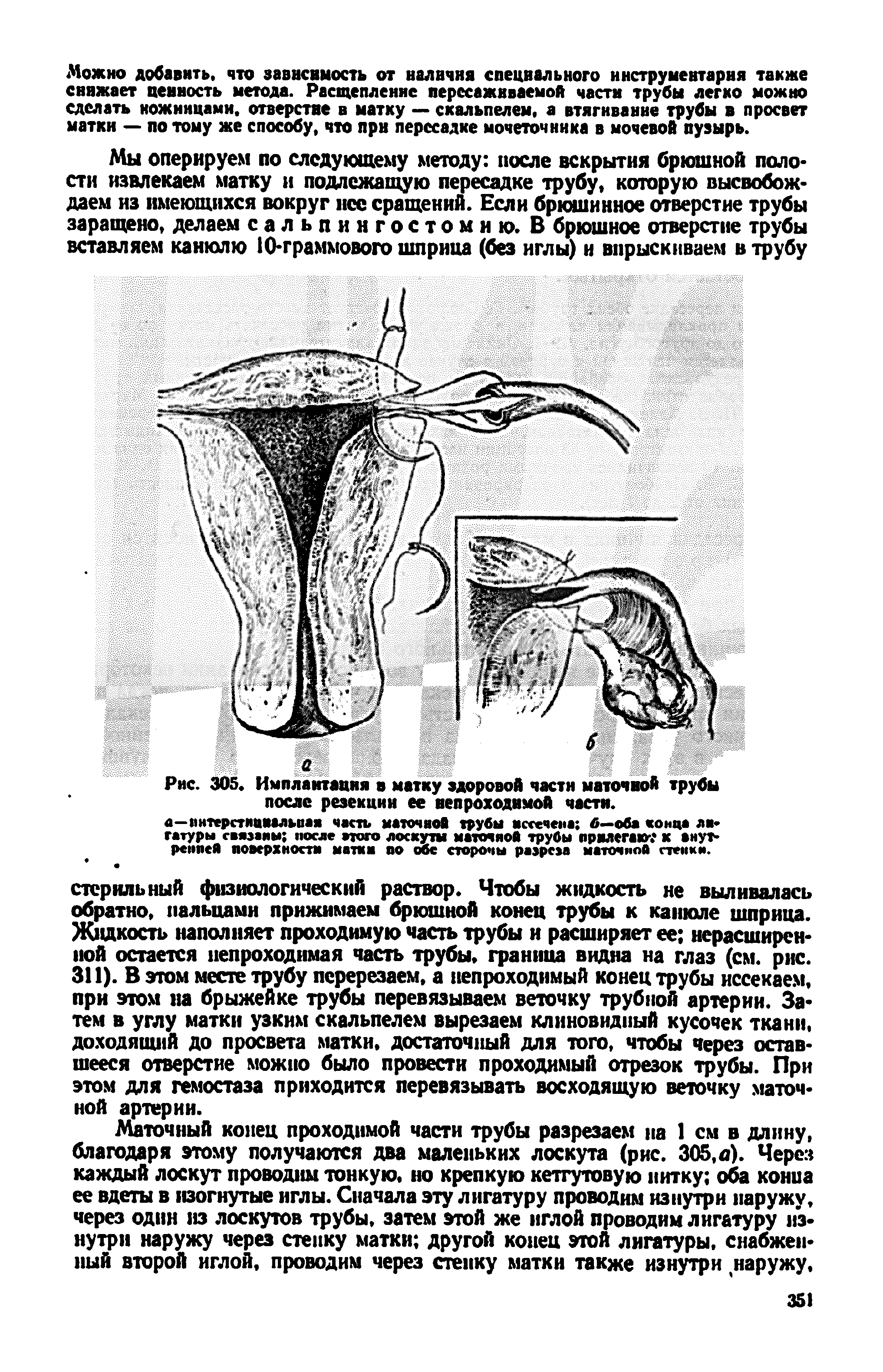 Рис. 305. Имплантация в матку здоровой части маточной трубы после резекции ее непроходимой части.