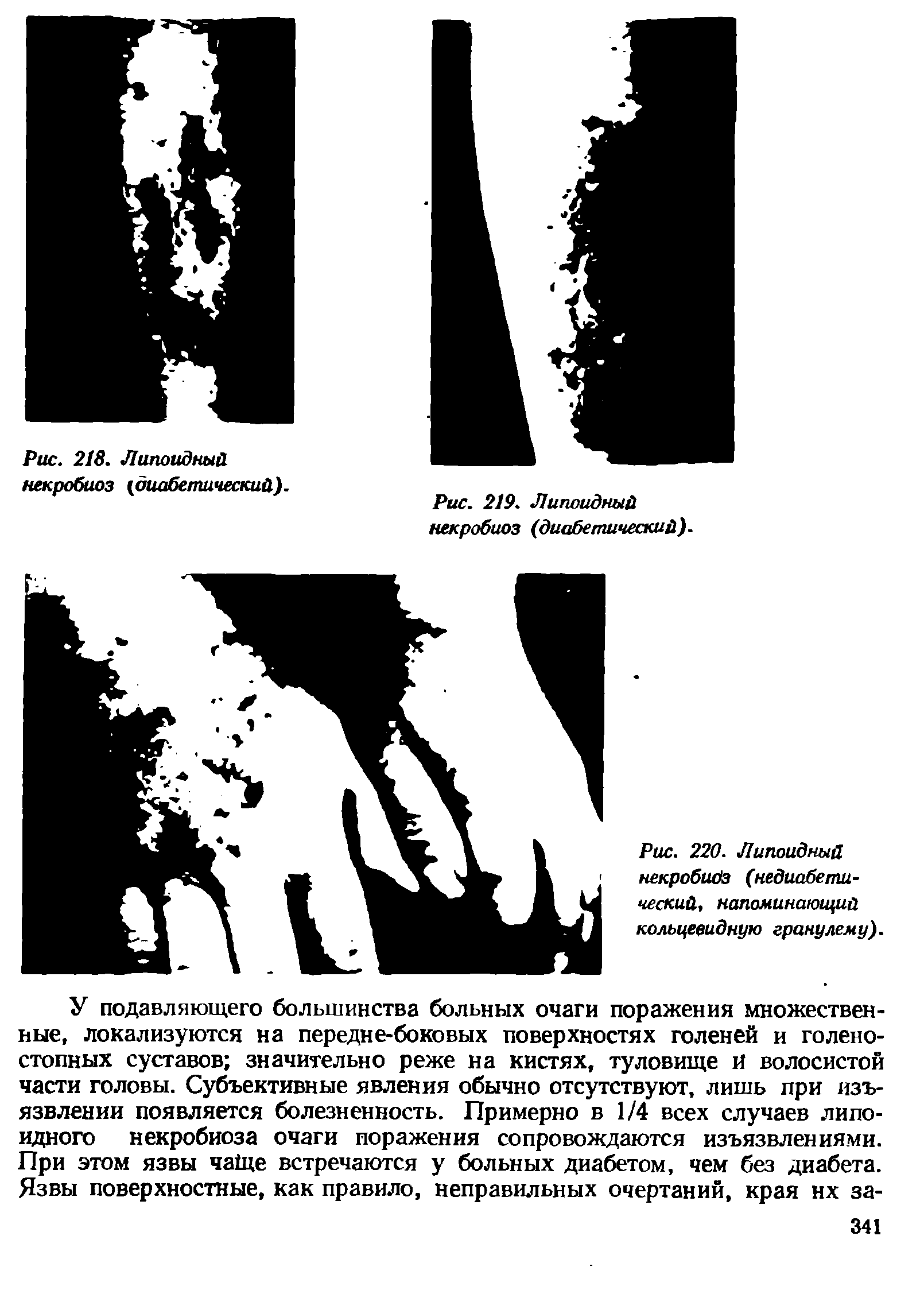 Рис. 220. Липоидный некробидз (недиабетический, напоминающий кольцевидную гранулему).