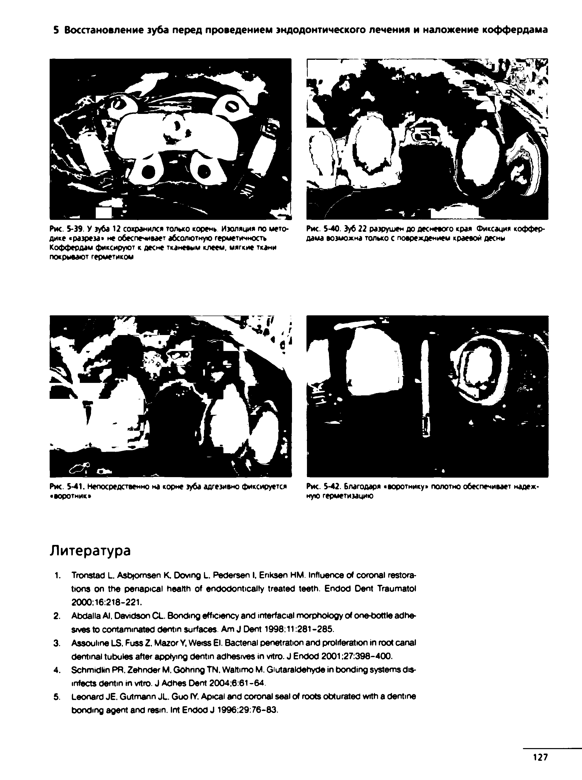 Рис. 5-39. У зуба 12 сохранился только корень Изоляция по методике разреза не обеспечивает абсолютную герметичность Коффердам фиксируют к десне тканевым клеем, мягкие ткани покрывают герметиком...