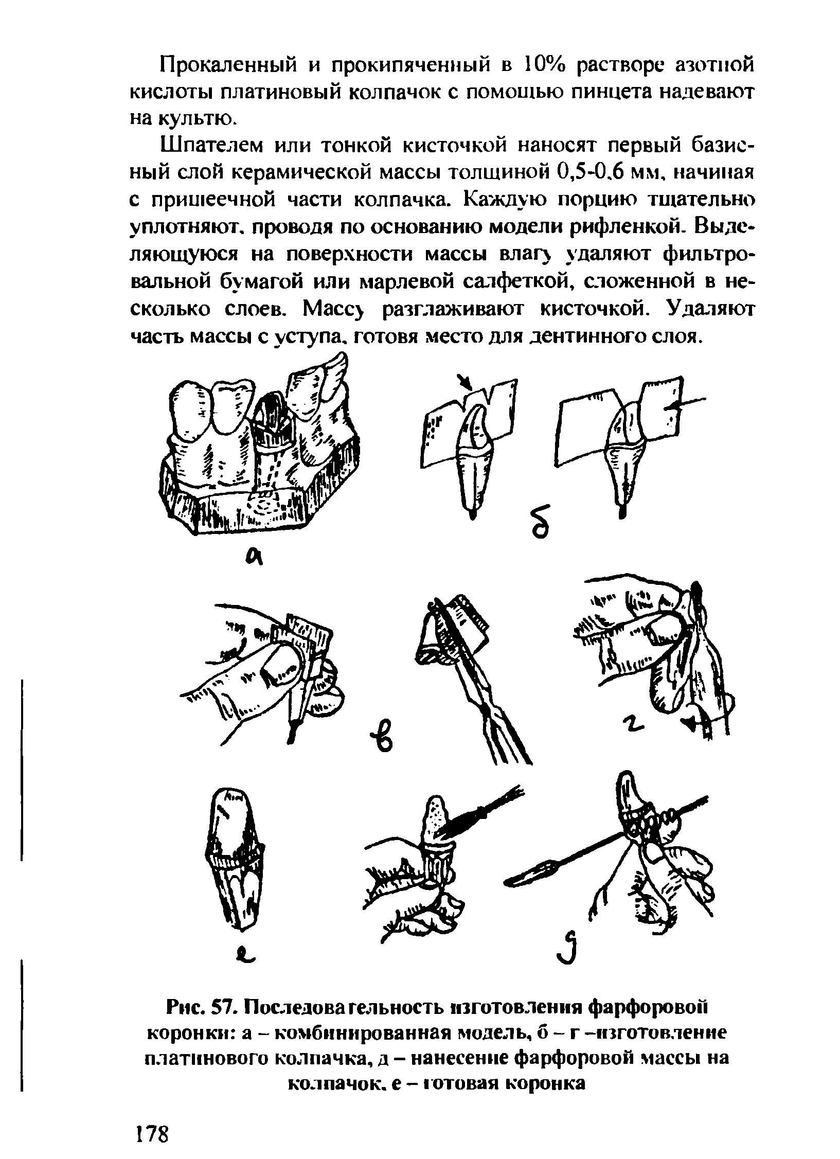 Рис. 57. Последовательность изготовления фарфоровой коронки а - комбинированная модель, б - г -изготовление платинового колпачка, д - нанесение фарфоровой массы на колпачок, е - готовая коронка...