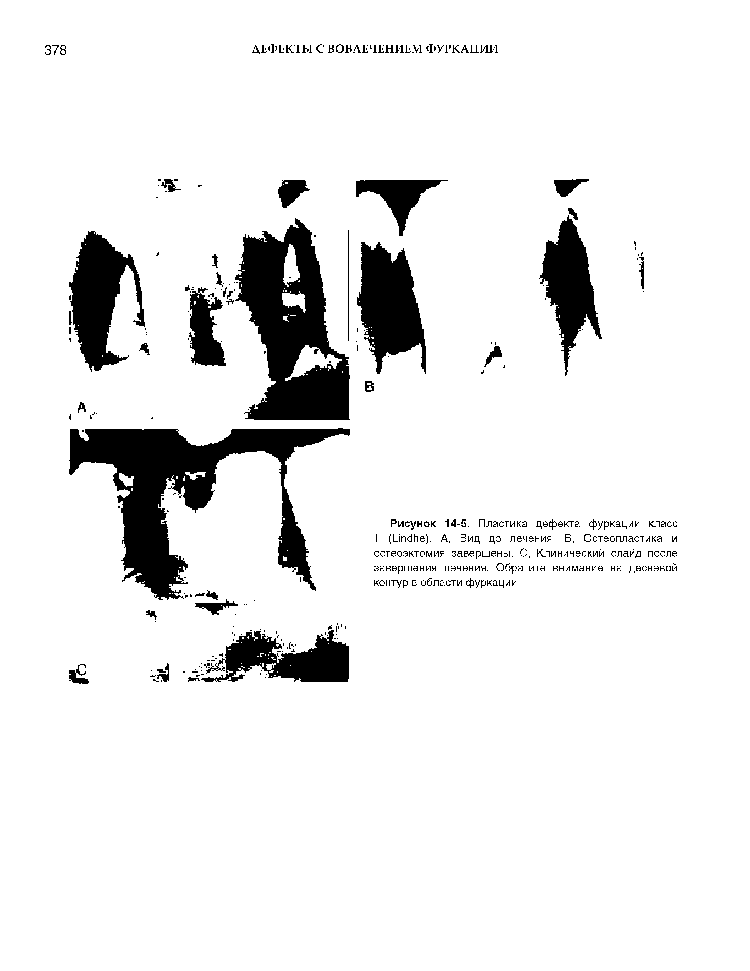 Рисунок 14-5. Пластика дефекта фуркации класс 1 (Ыпс1Ье). А, Вид до лечения. В, Остеопластика и остеоэктомия завершены. С, Клинический слайд после завершения лечения. Обратите внимание на десневой контур в области фуркации.