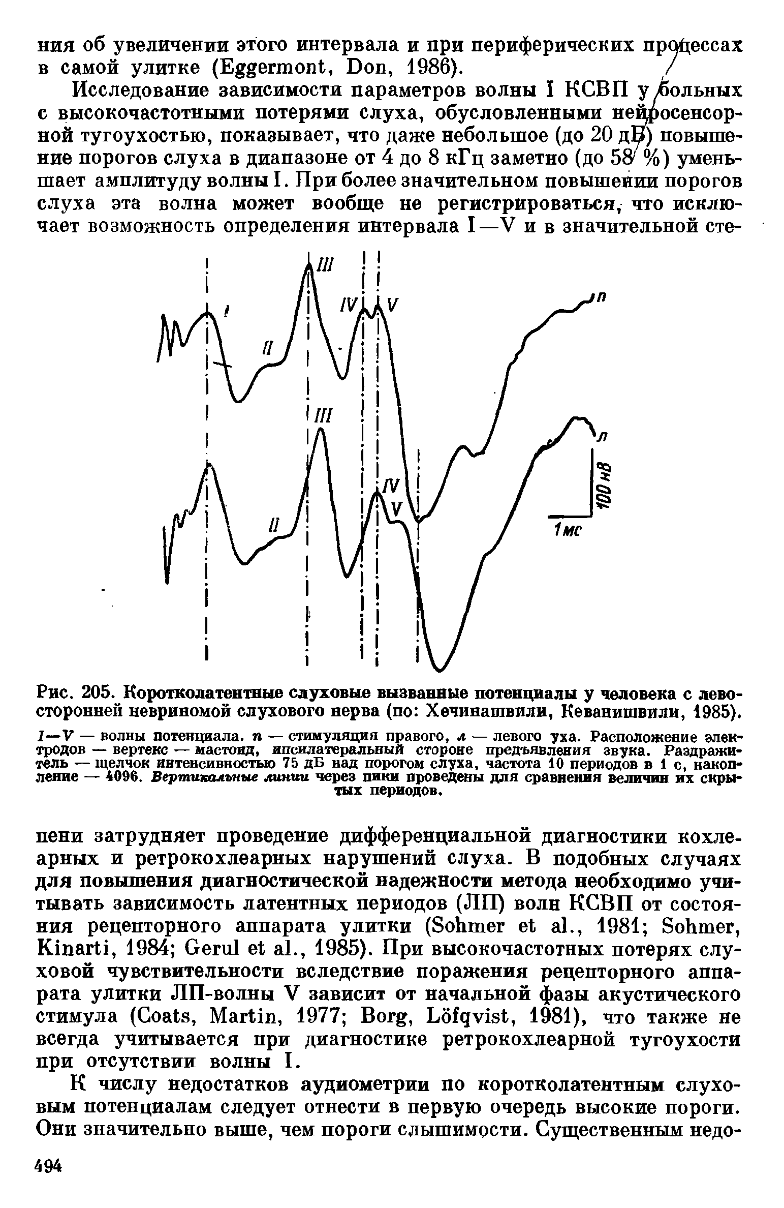 Рис. 205. Коротколатентные слуховые вызванные потенциалы у человека с левосторонней невриномой слухового нерва (по Хечинашвили, Кеванишвили, 1985).