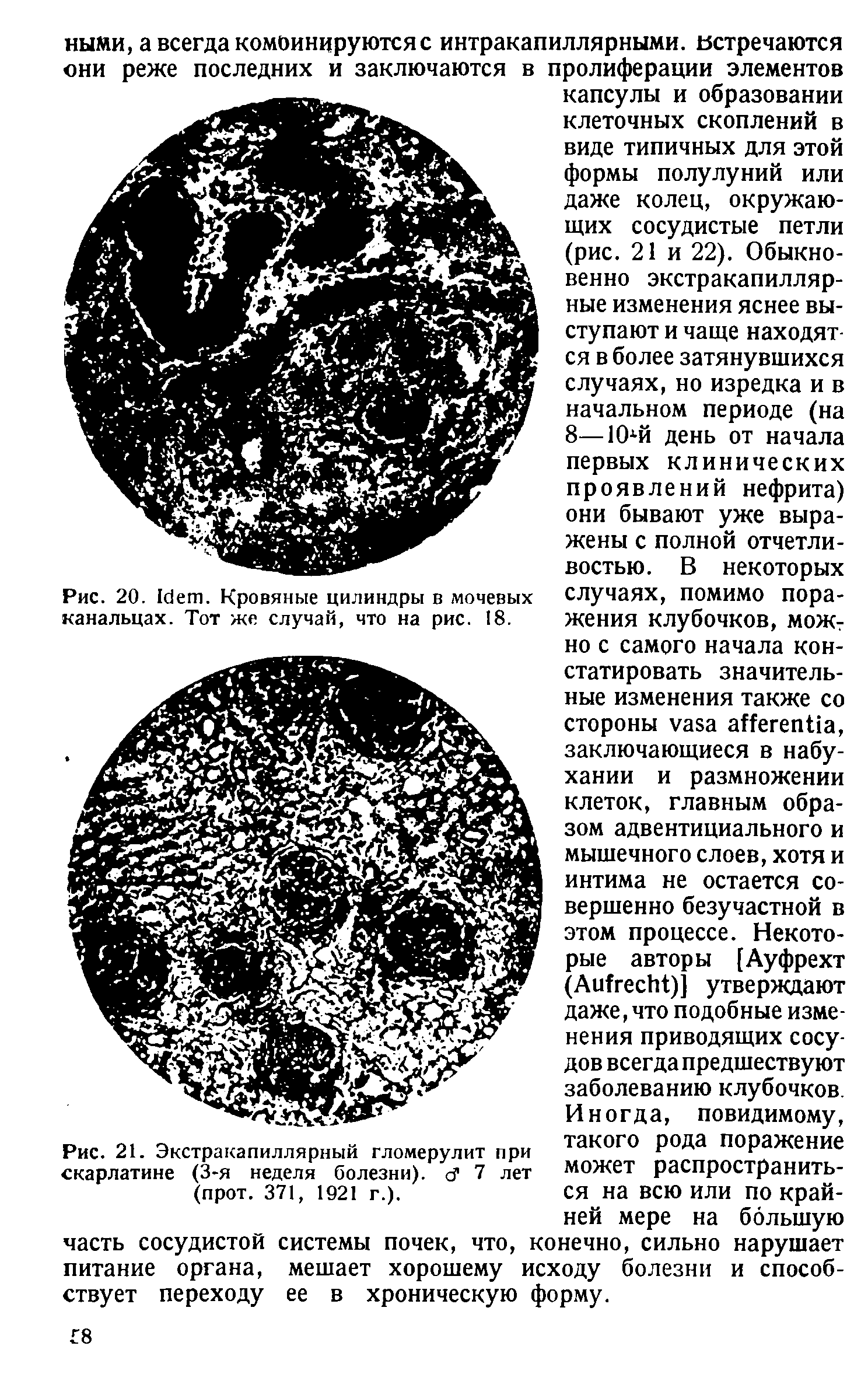 Рис. 20. I . Кровяные цилиндры в мочевых канальцах. Тот же случай, что на рис. 18.