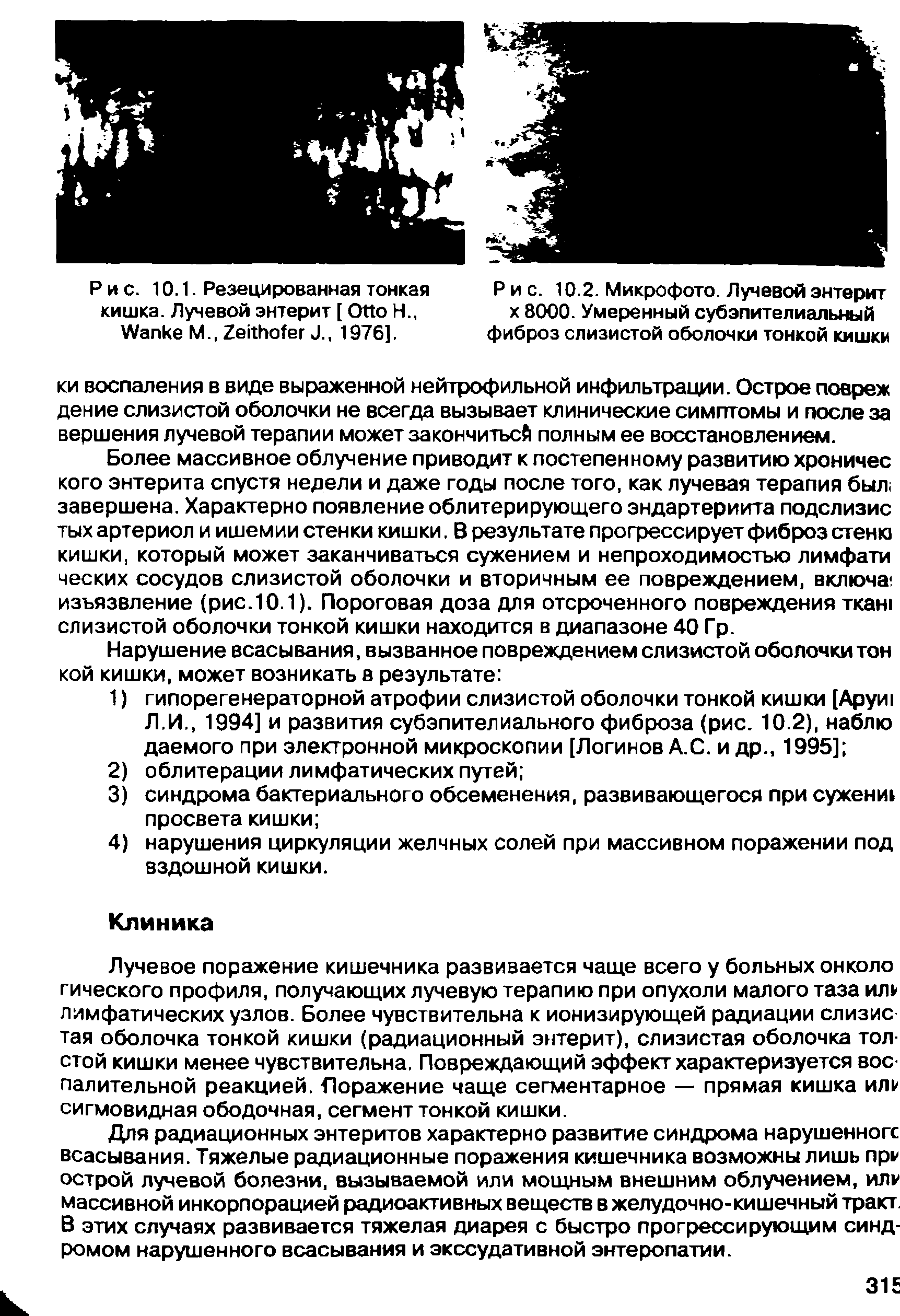 Рис. 10.2. Микрофото. Лучевой энтерит х 8000. Умеренный субэпителиальный фиброз слизистой оболочки тонкой кишки...