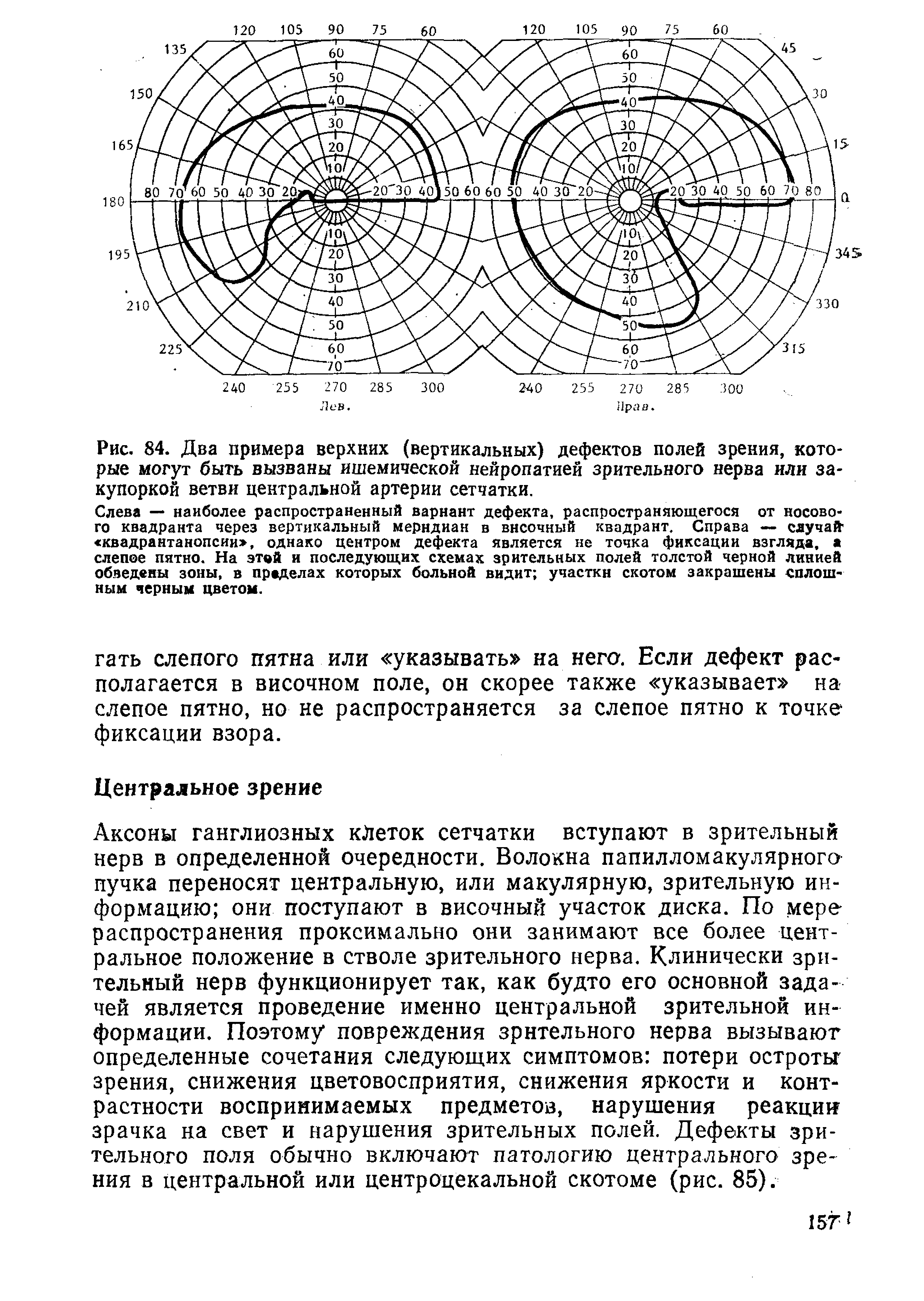 Рис. 84. Два примера верхних (вертикальных) дефектов полей зрения, которые могут быть вызваны ишемической нейропатией зрительного нерва или закупоркой ветви центральной артерии сетчатки.