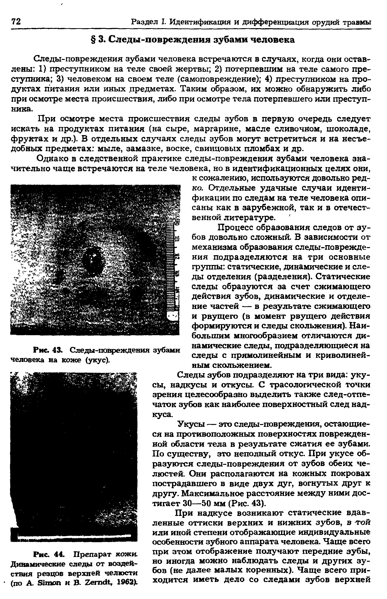 Рис. 43. Следы-повреждения зубами человека на коже (укус).