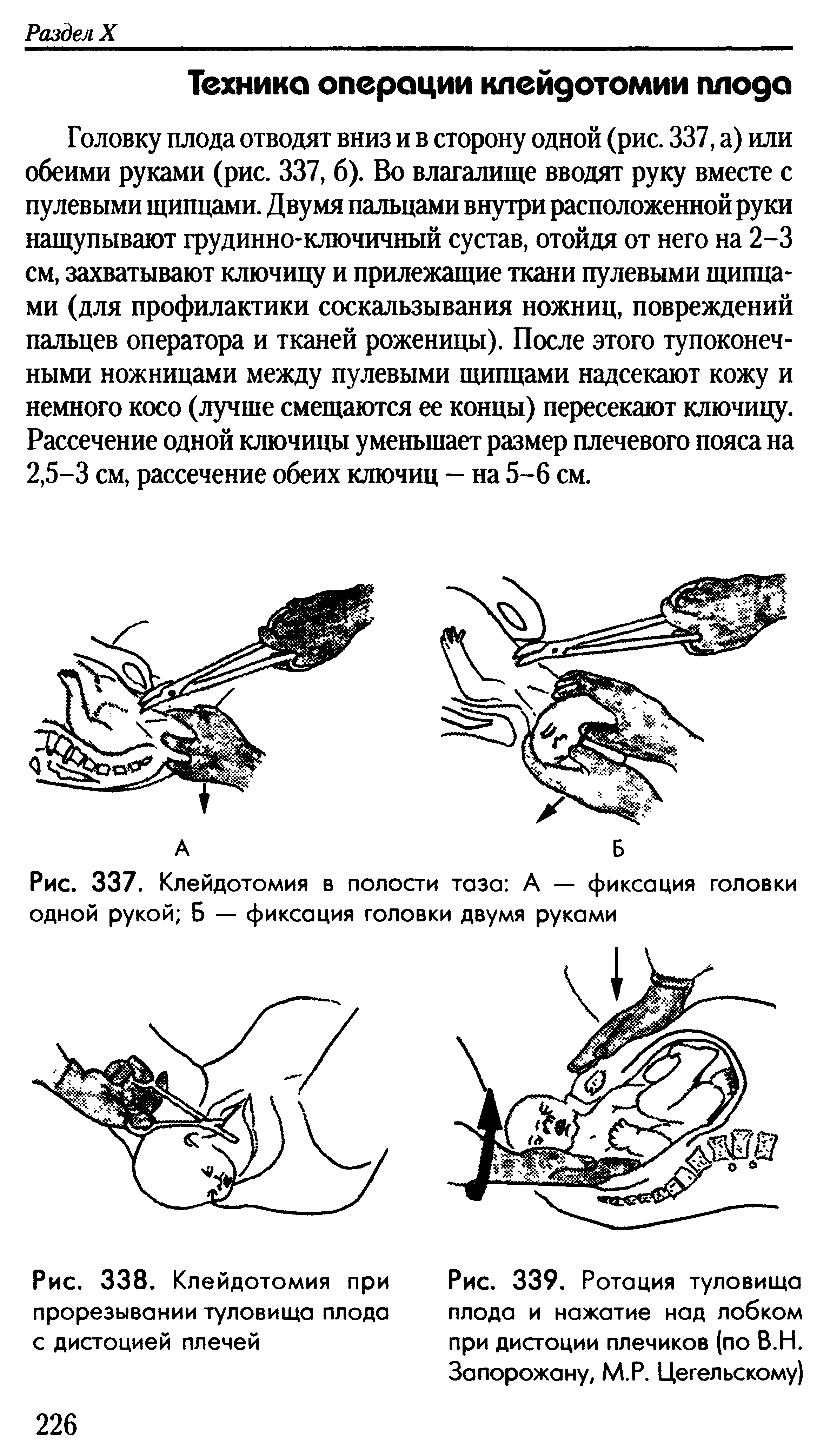 Рис. 337. Клейдотомия в полости таза А — фиксация головки одной рукой Б — фиксация головки двумя руками...