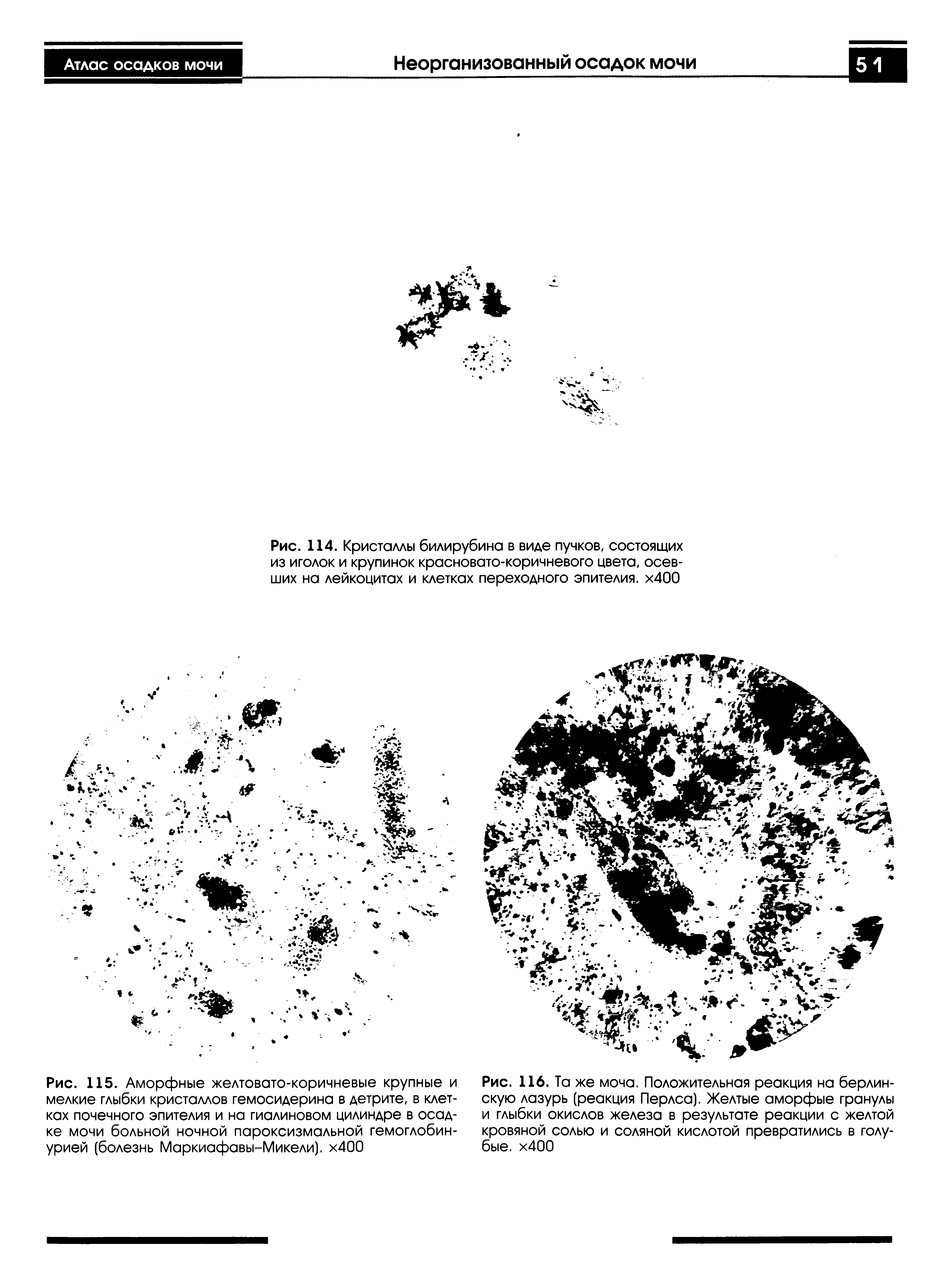 Рис. 114. Кристаллы билирубина в виде пучков, состоящих из иголок и крупинок красновато-коричневого цвета, осевших на лейкоцитах и клетках переходного эпителия. х400...