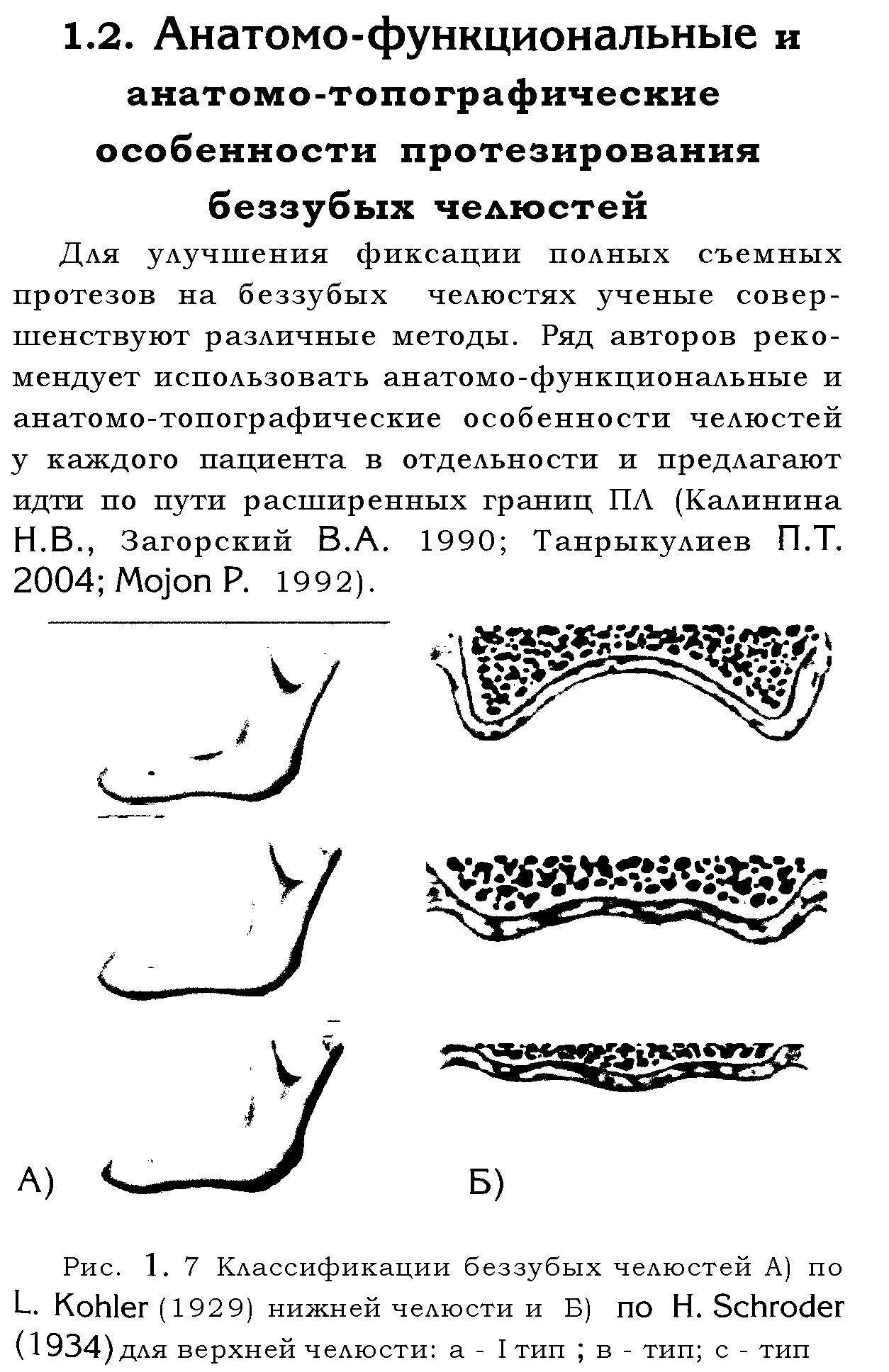 Рис. 1. 7 Классификации беззубых челюстей А) по L. K (1929) нижней челюсти и Б) по Н. S (1934) для верхней челюсти а - I тип в - тип с - тип...