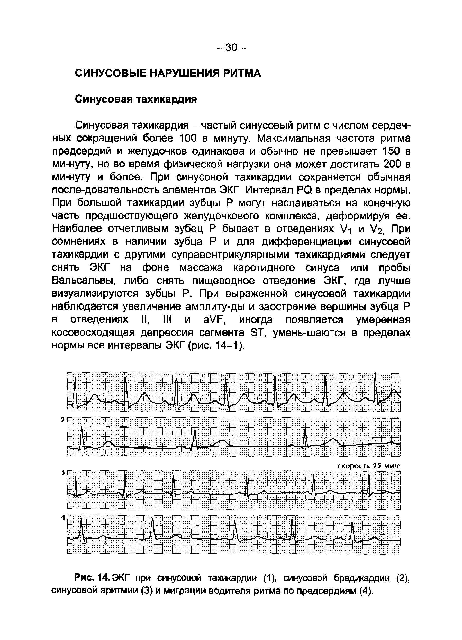 Рис. 14. ЭКГ при синусовой тахикардии (1), синусовой брадикардии (2), синусовой аритмии (3) и миграции водителя ритма по предсердиям (4).