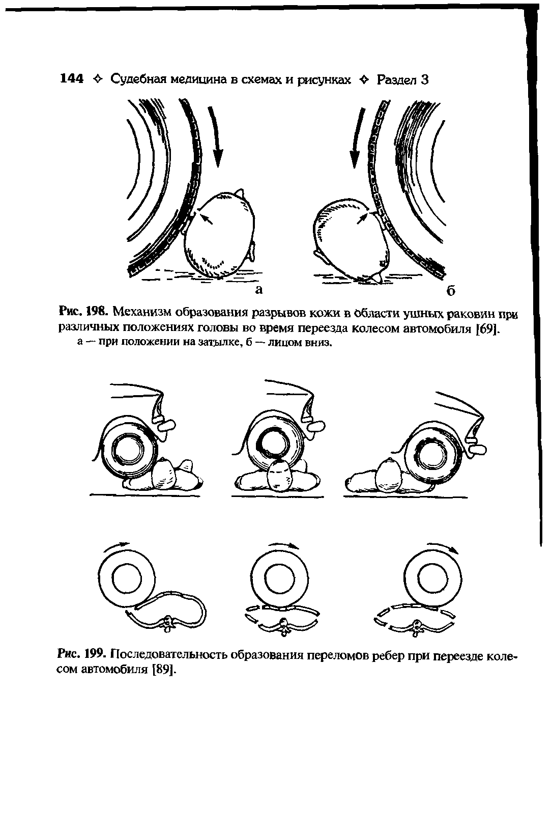 Рис. 198. Механизм образования разрывов кожи в Области ушных раковин при различных положениях головы во время переезда колесом автомобиля [69].
