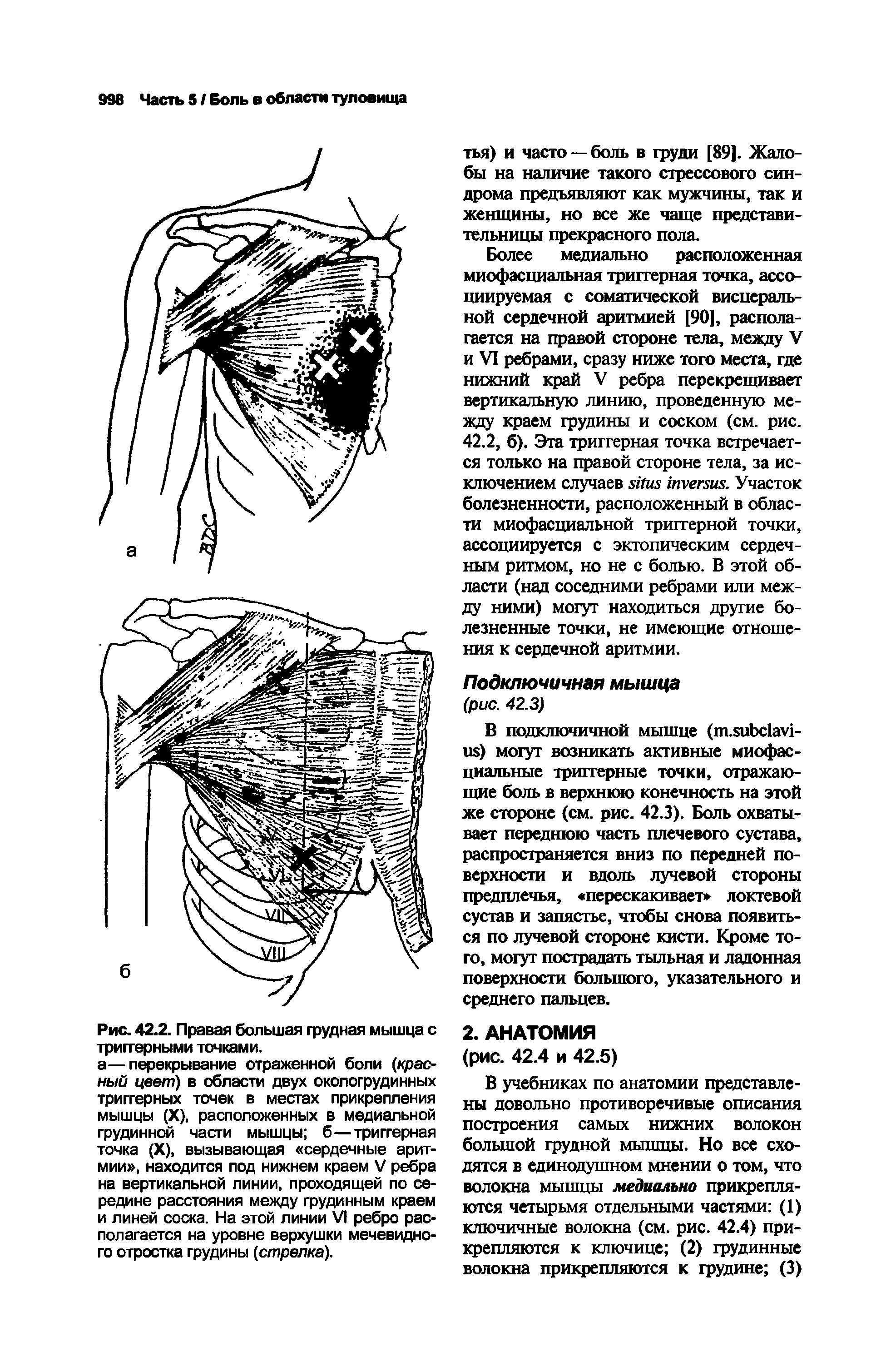 Рис. 42.2. Правая большая грудная мышца с триггерными точками.