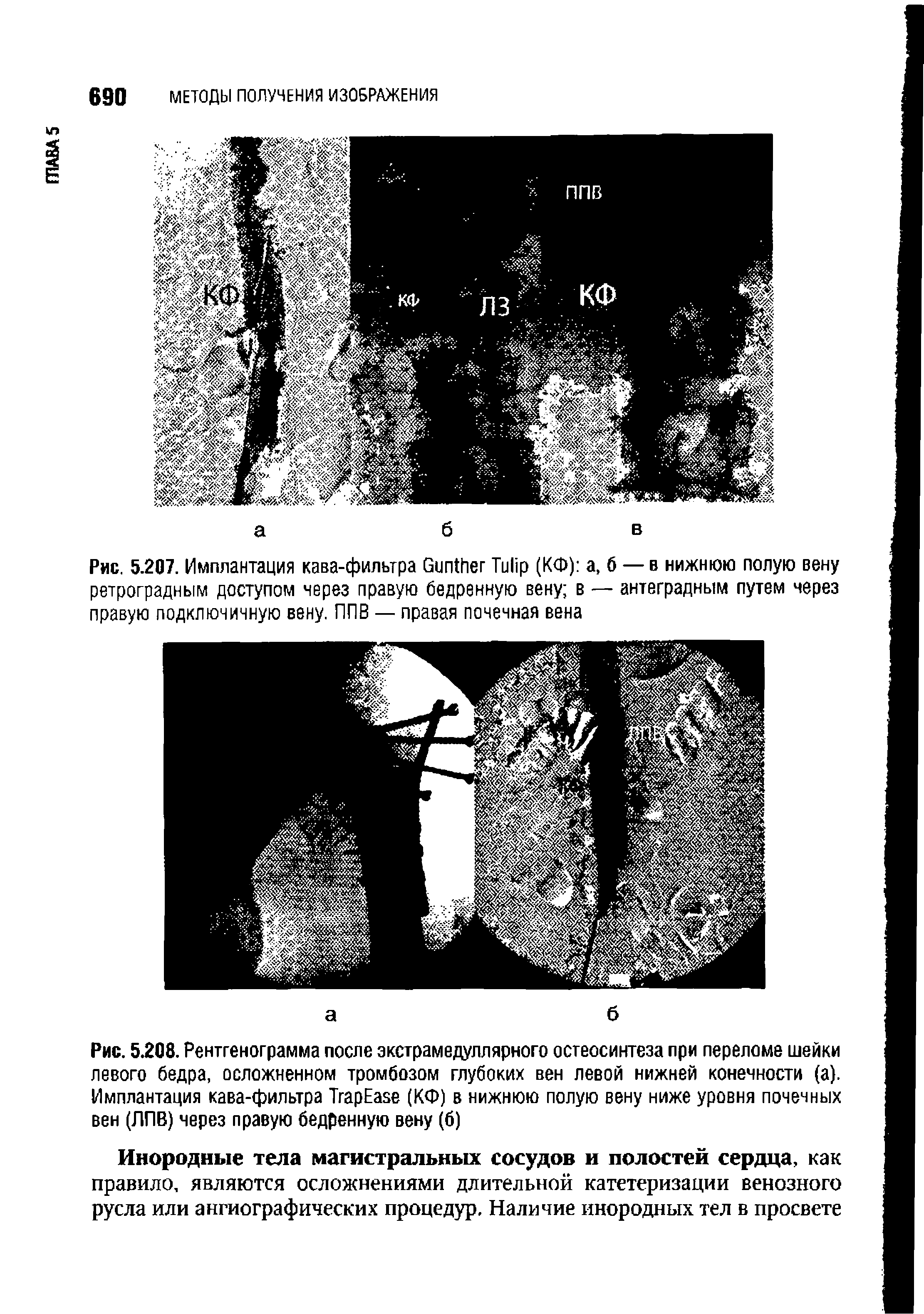 Рис. 5.207. Имплантация кава-фильтра G T (КФ) а, б — в нижнюю полую вену ретроградным доступом через правую бедренную вену в — антеградным путем через правую подключичную вену. ППВ — правая почечная вена...