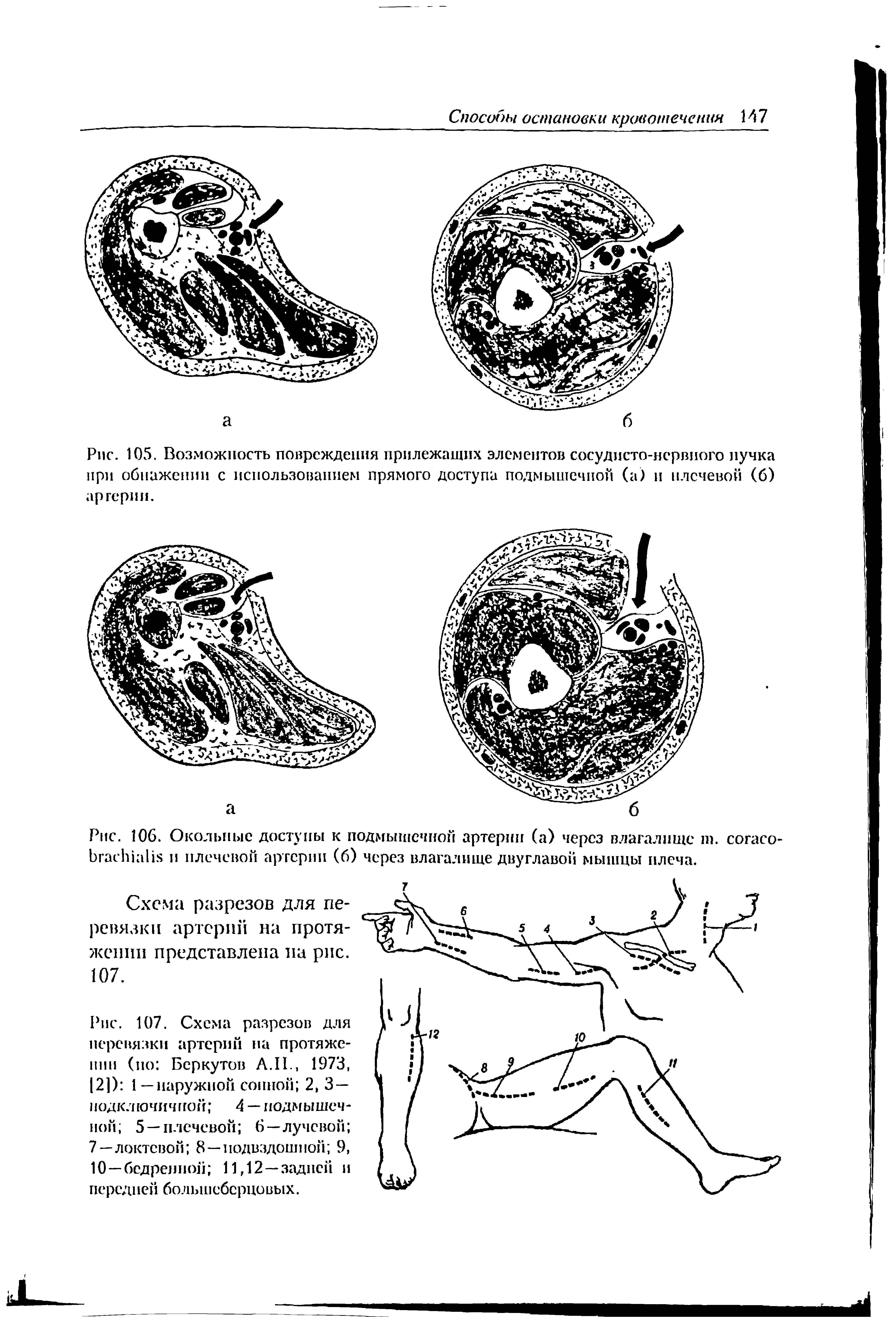 Рис. 105. Возможность повреждения прилежащих элементов сосудисто-нервного пучка при обнажении с использованием прямого доступа подмышечной (а) и плечевой (б) артерии.