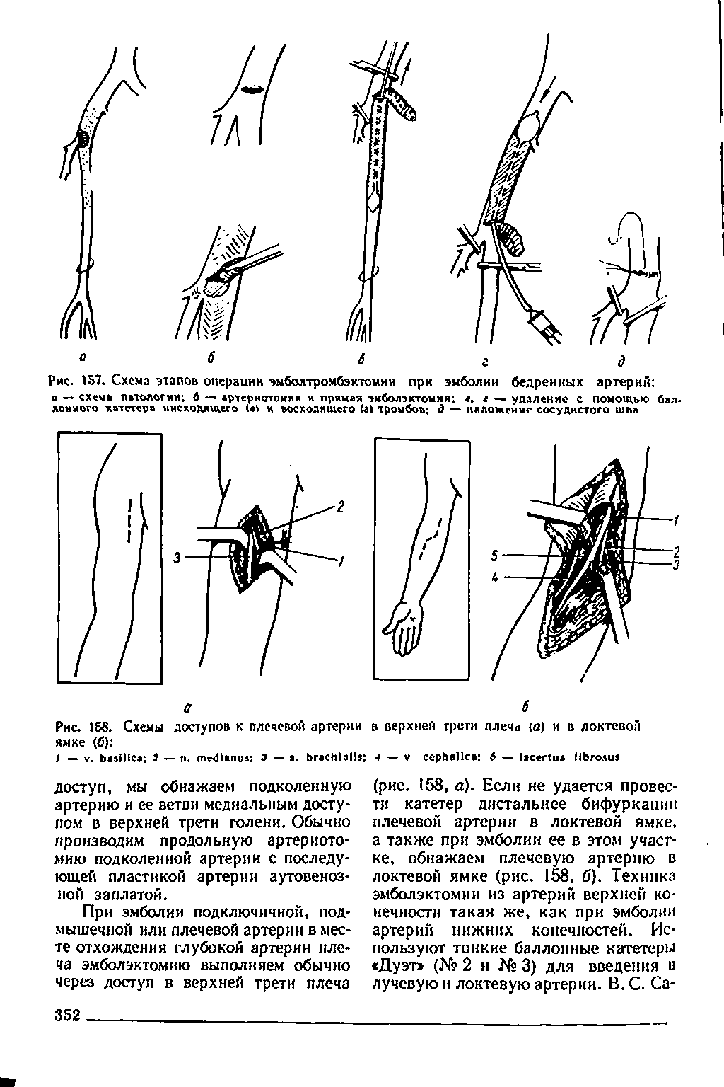 Рис. 158. Схемы доступов к плечевой артерии в верхней трети плеча г) и в локтевой ямке (б) ...
