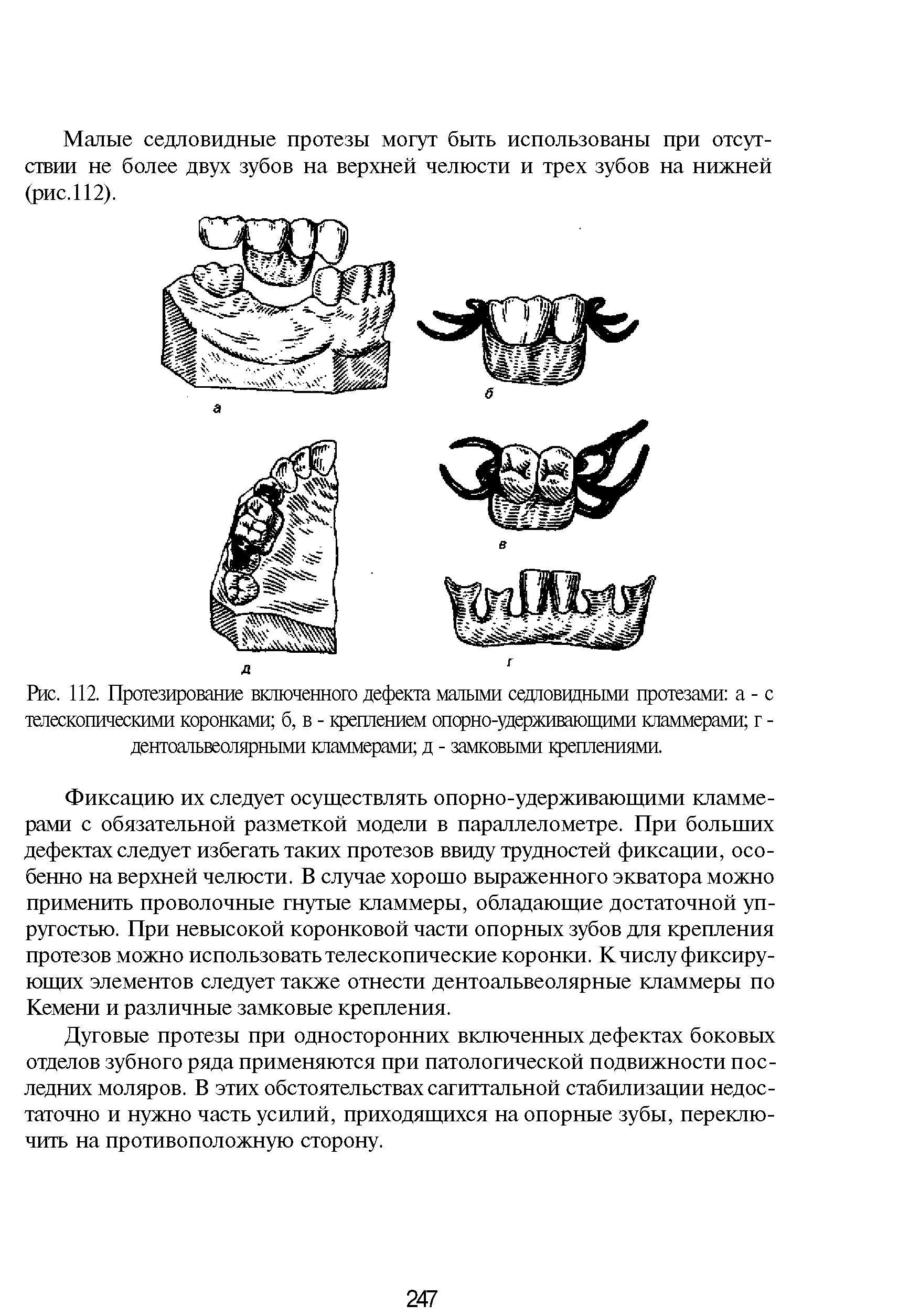 Рис. 112. Протезирование включенного дефекта малыми седдовцдными протезами а - с телескопическими коронками б, в - креплением опсрно-удерживающими Кламмерами г -дентоальвеолярными Кламмерами д - замковыми креплениями.